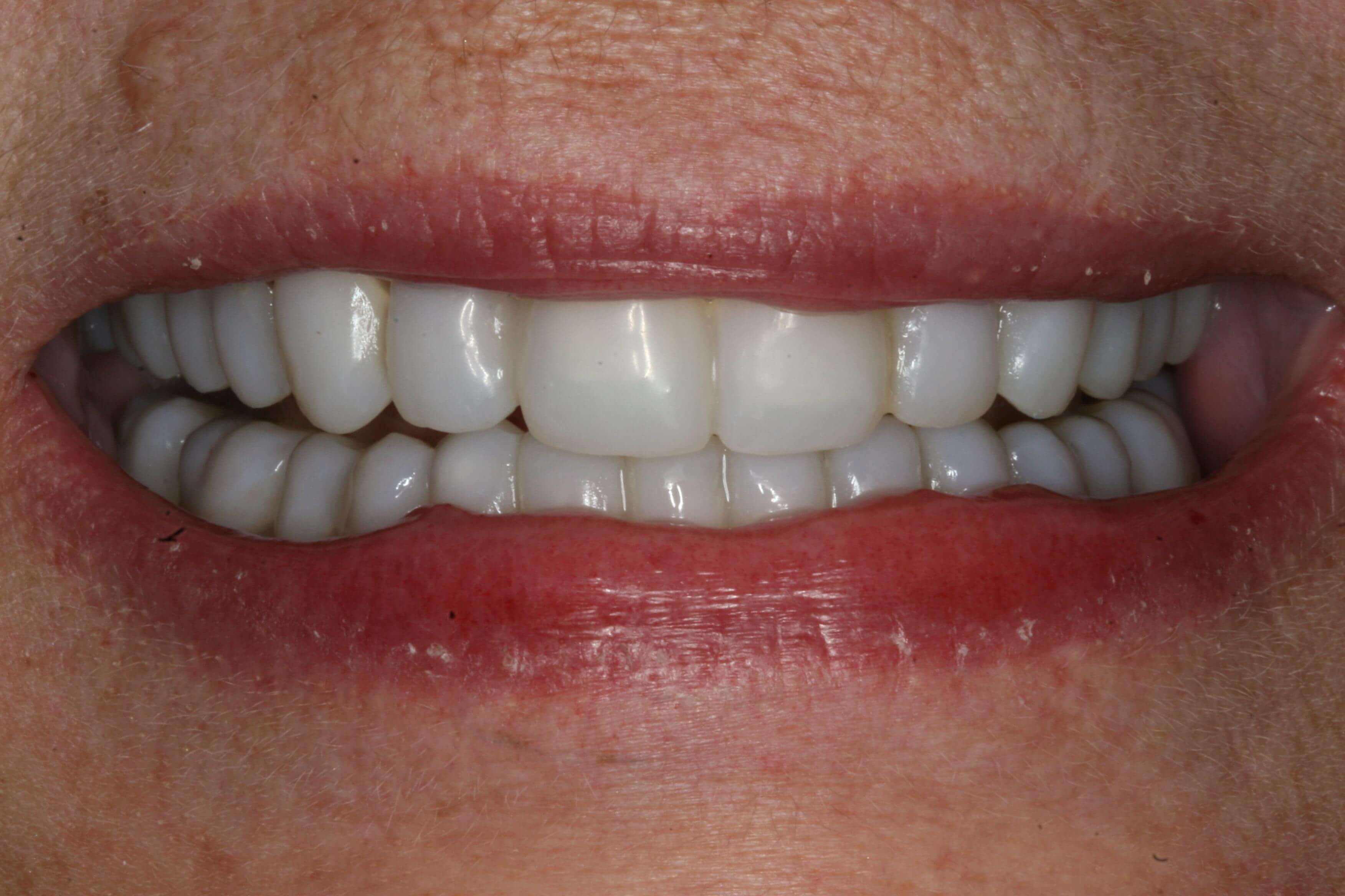 Provisional Restorations Provisional Smile