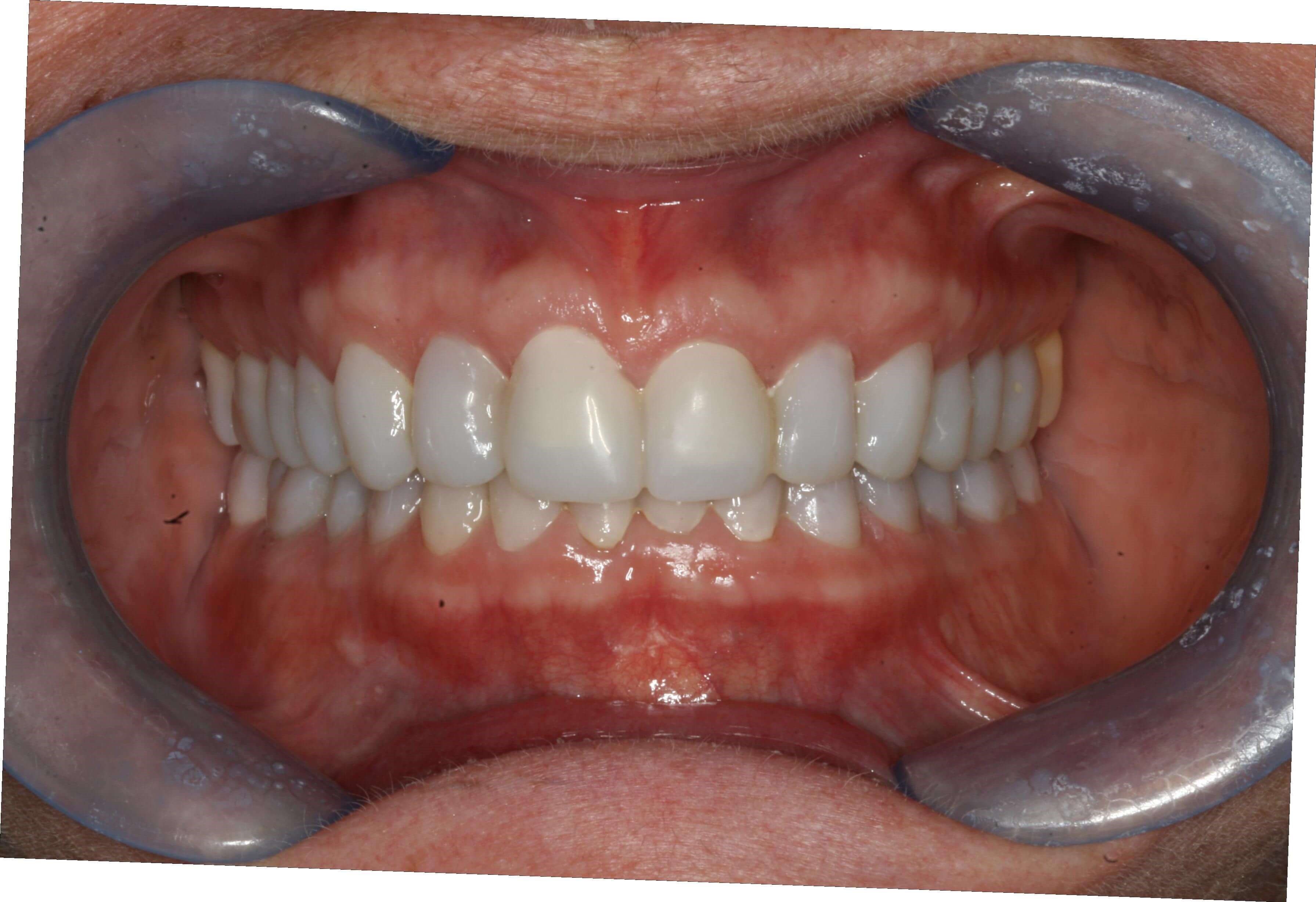 Provisional Restorations Provisional Retracted