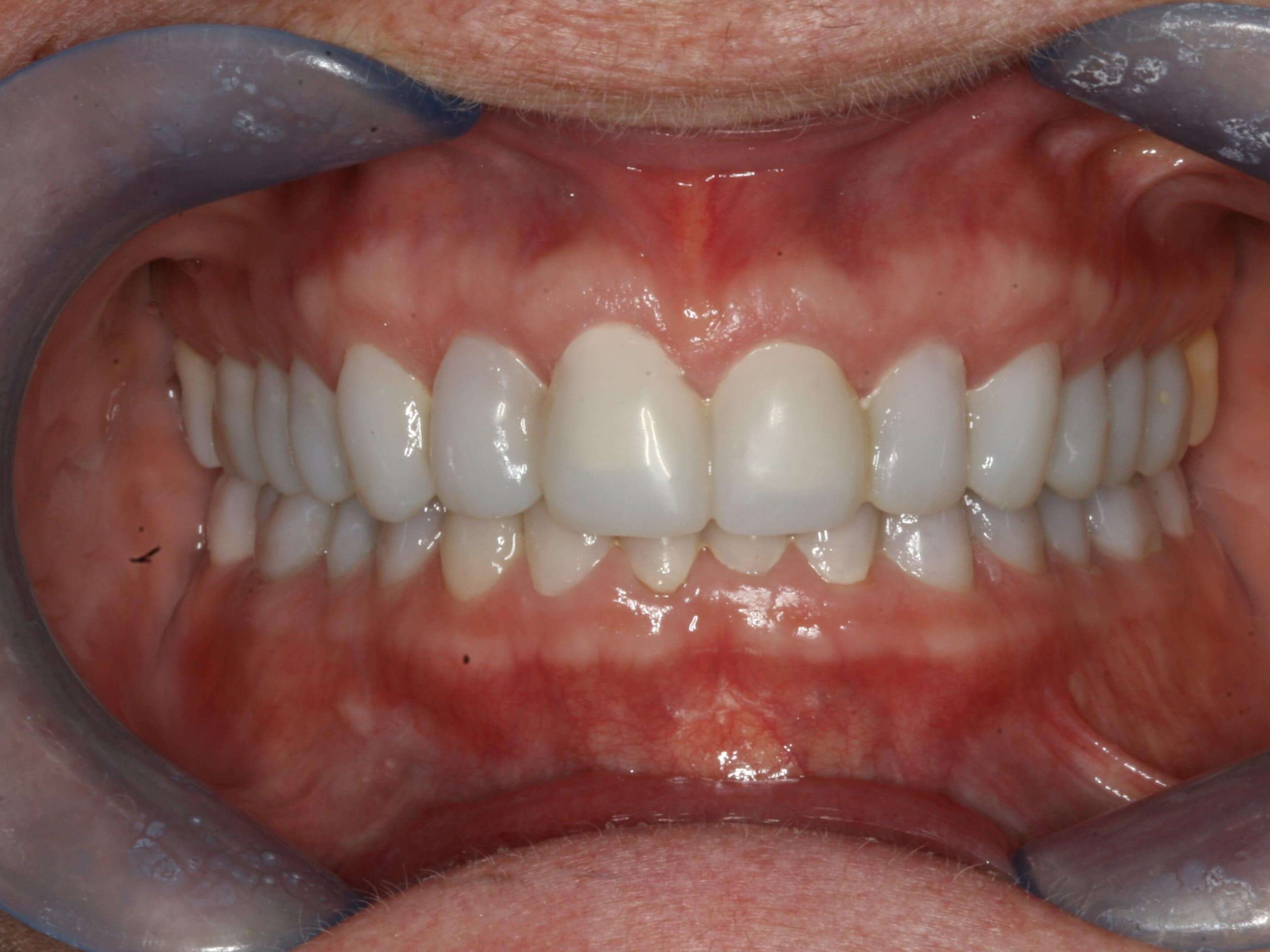 Provisional Restorations Provisional Retracted