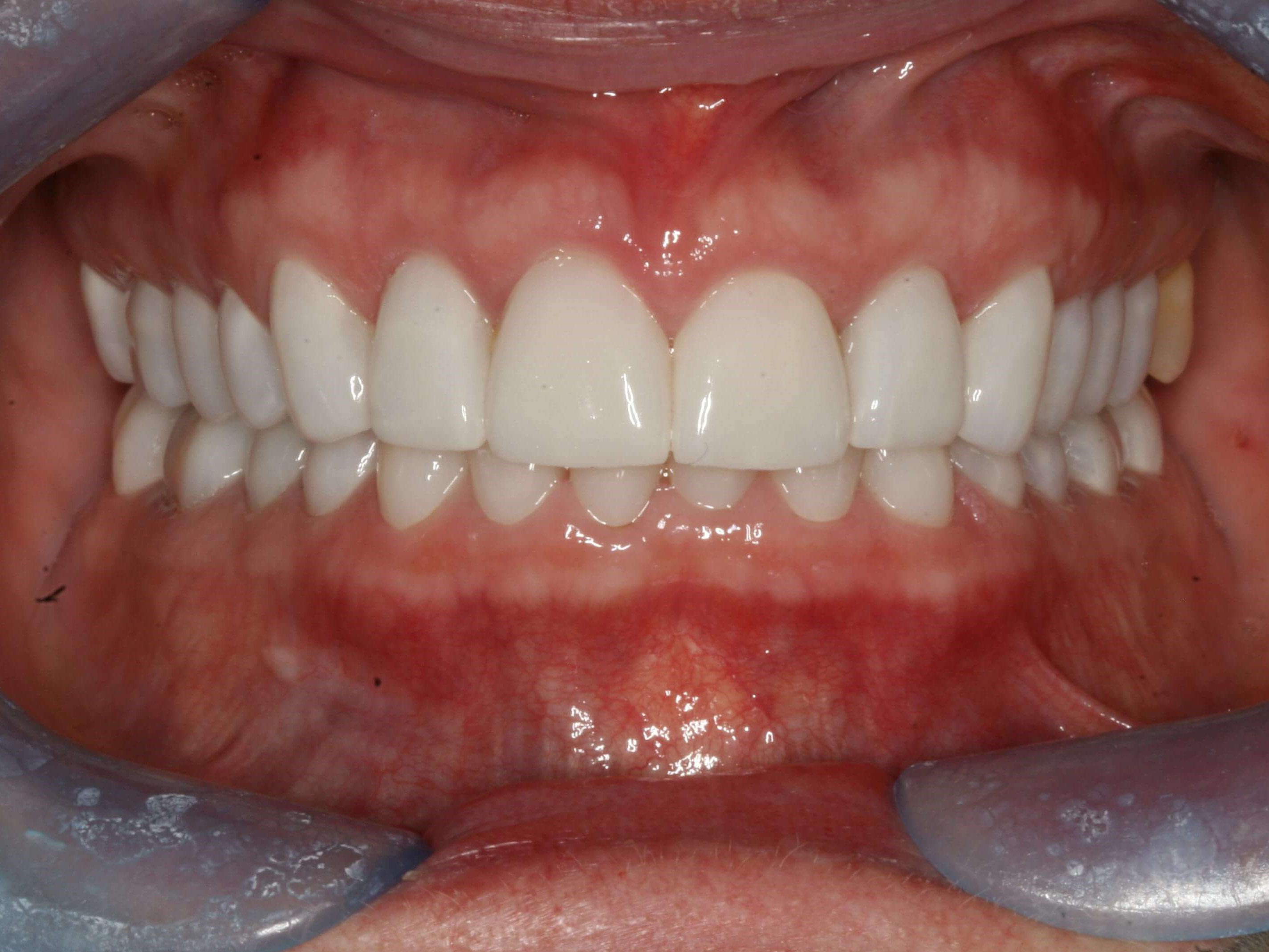 Final Finished Restorations After Closed