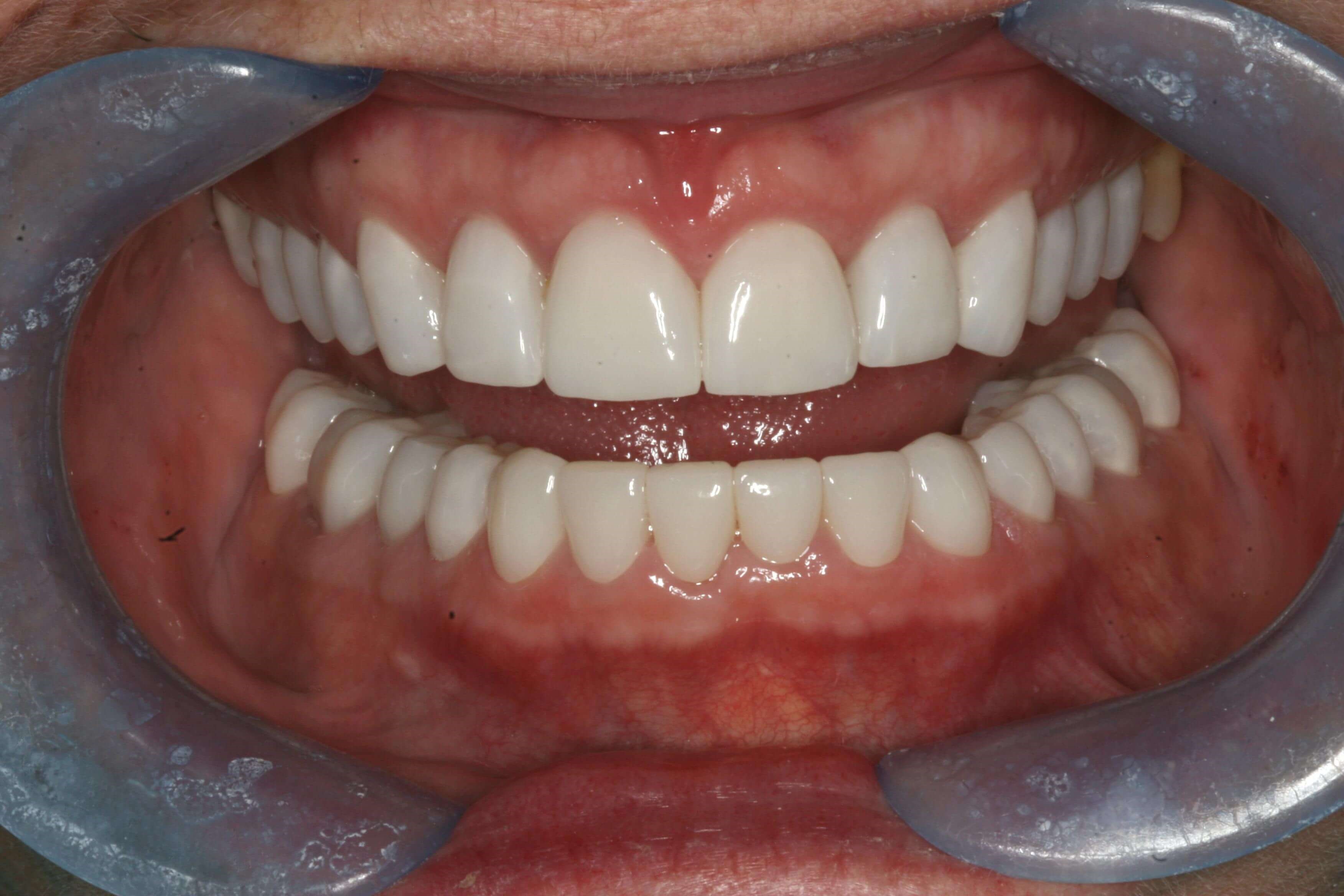 Final Finished Restorations After Open