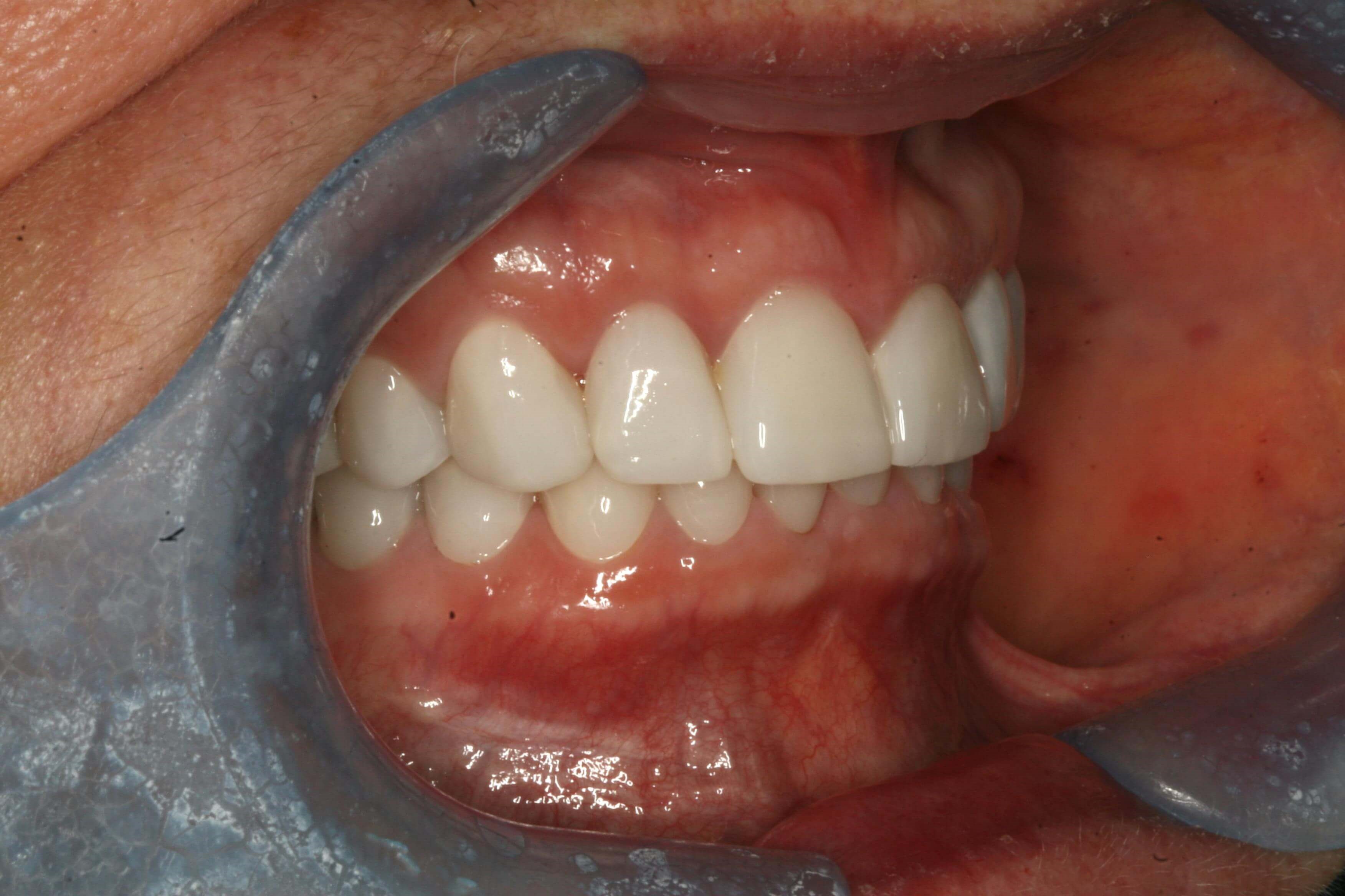 Final Finished Restorations Right Closed