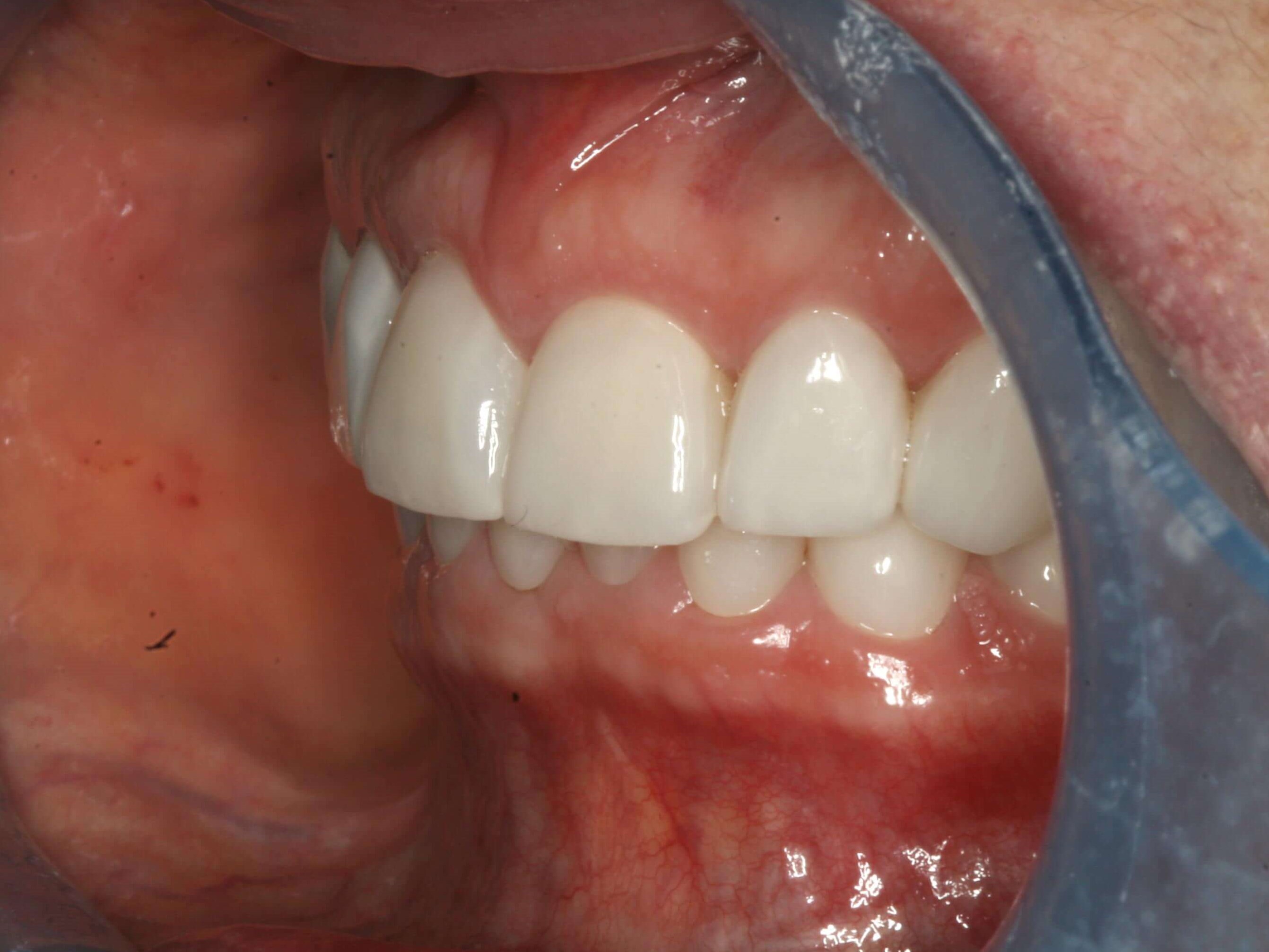 Final Finished Restorations Left Closed