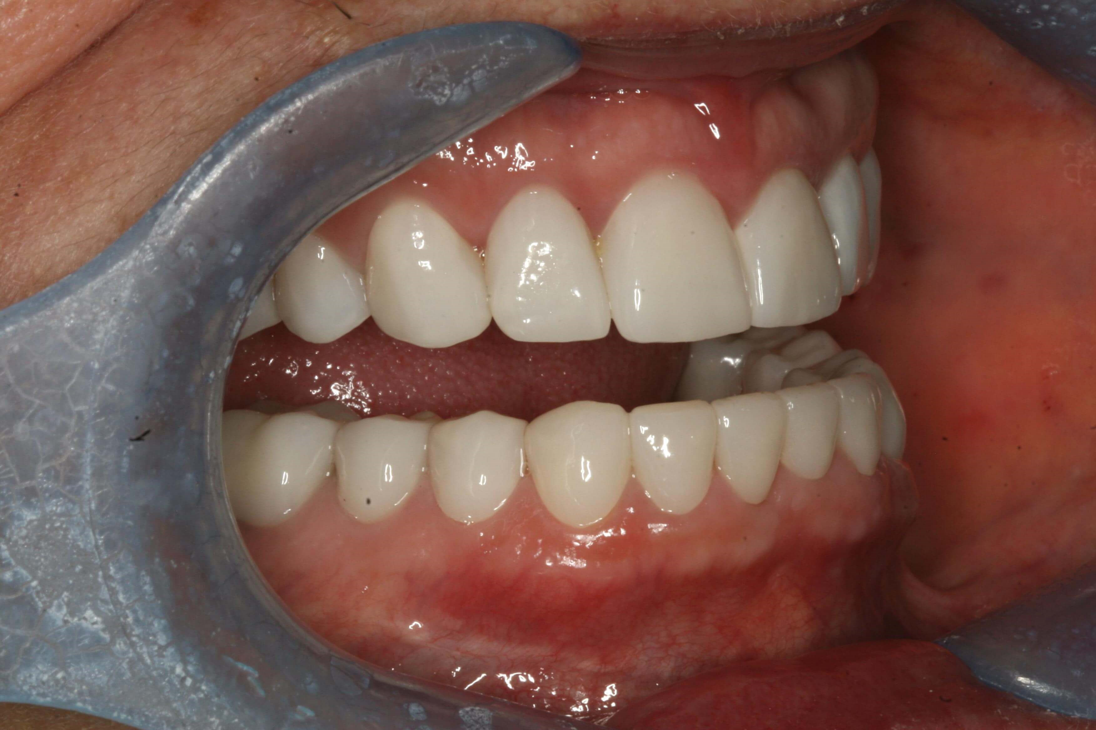 Final Finished Restorations Right Open