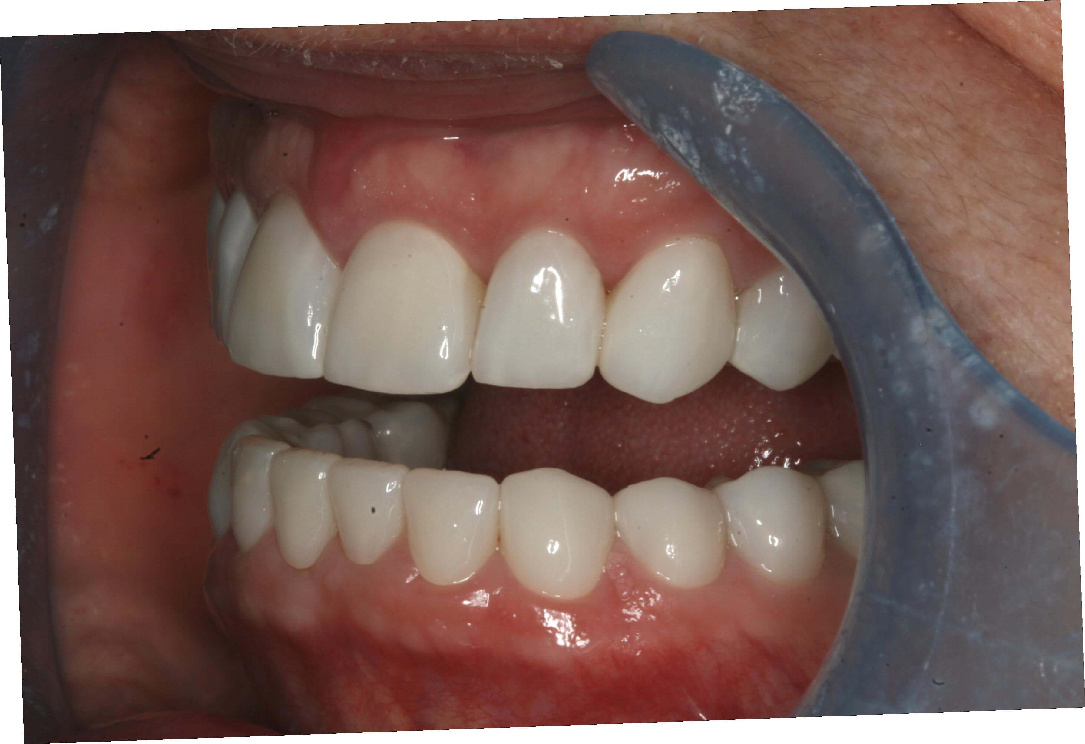 Final Finished Restorations Left Open