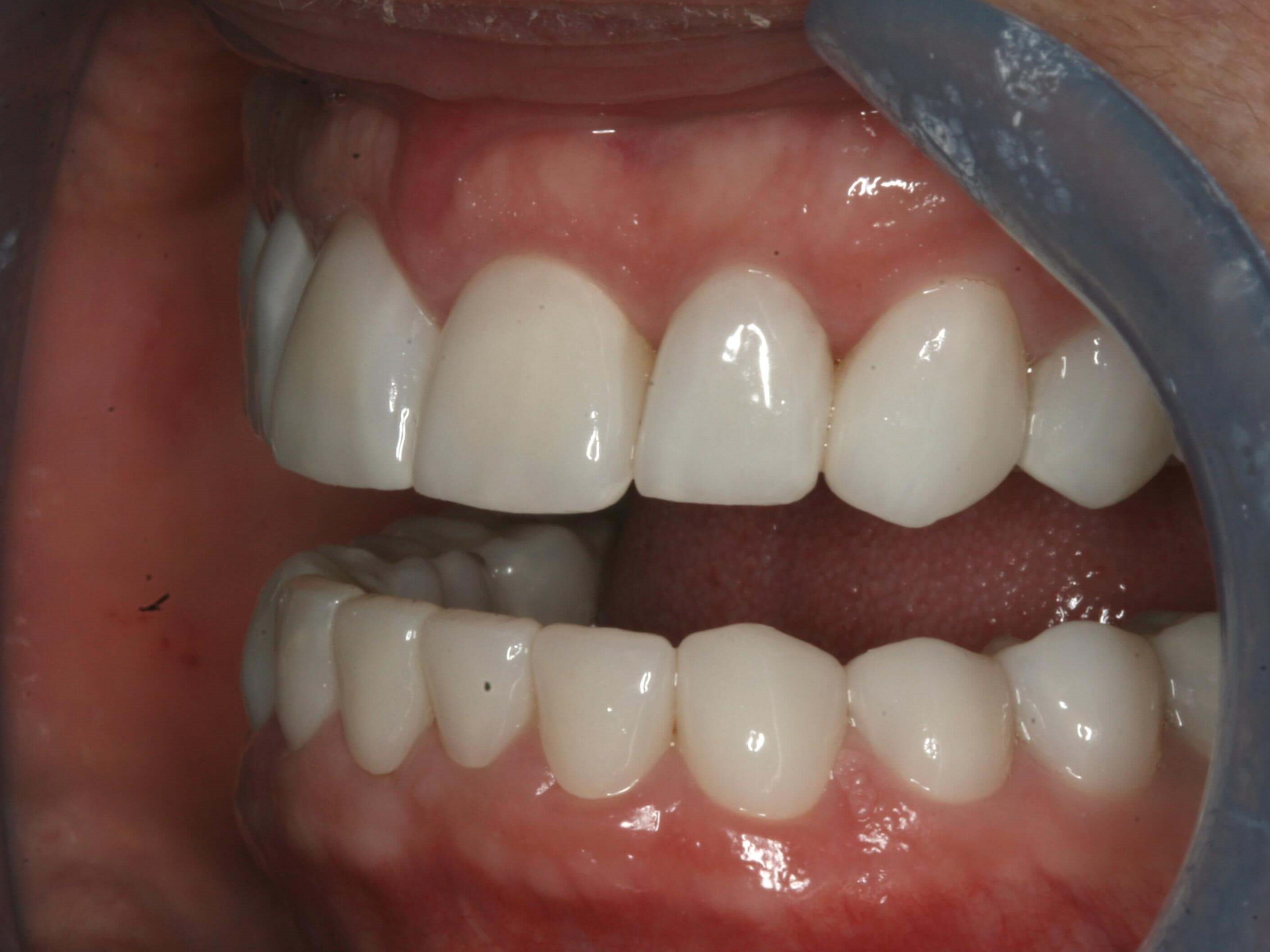 Final Finished Restorations Left Open