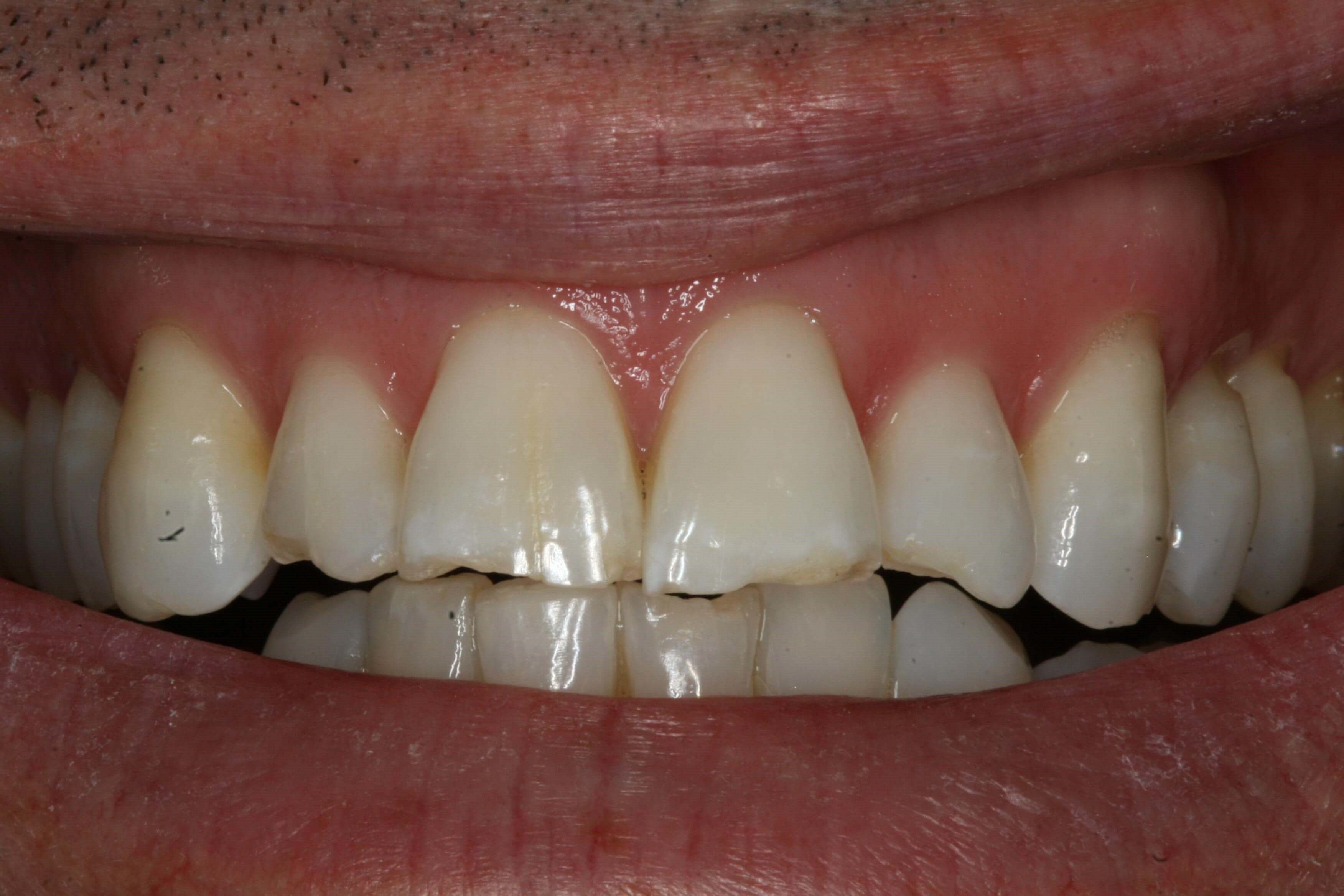 Dental Bonding One Visit Before