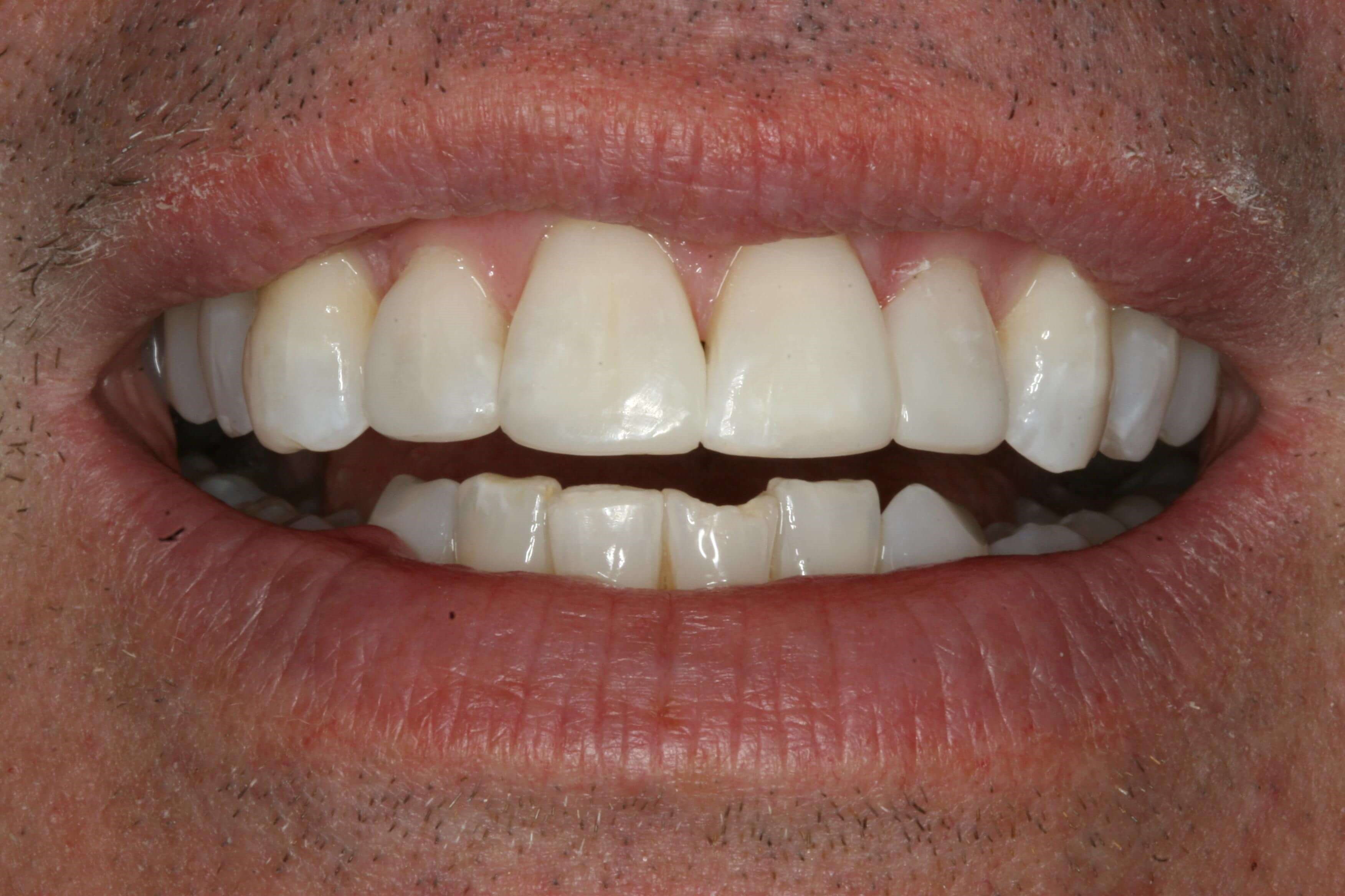 Dental Bonding One Visit After