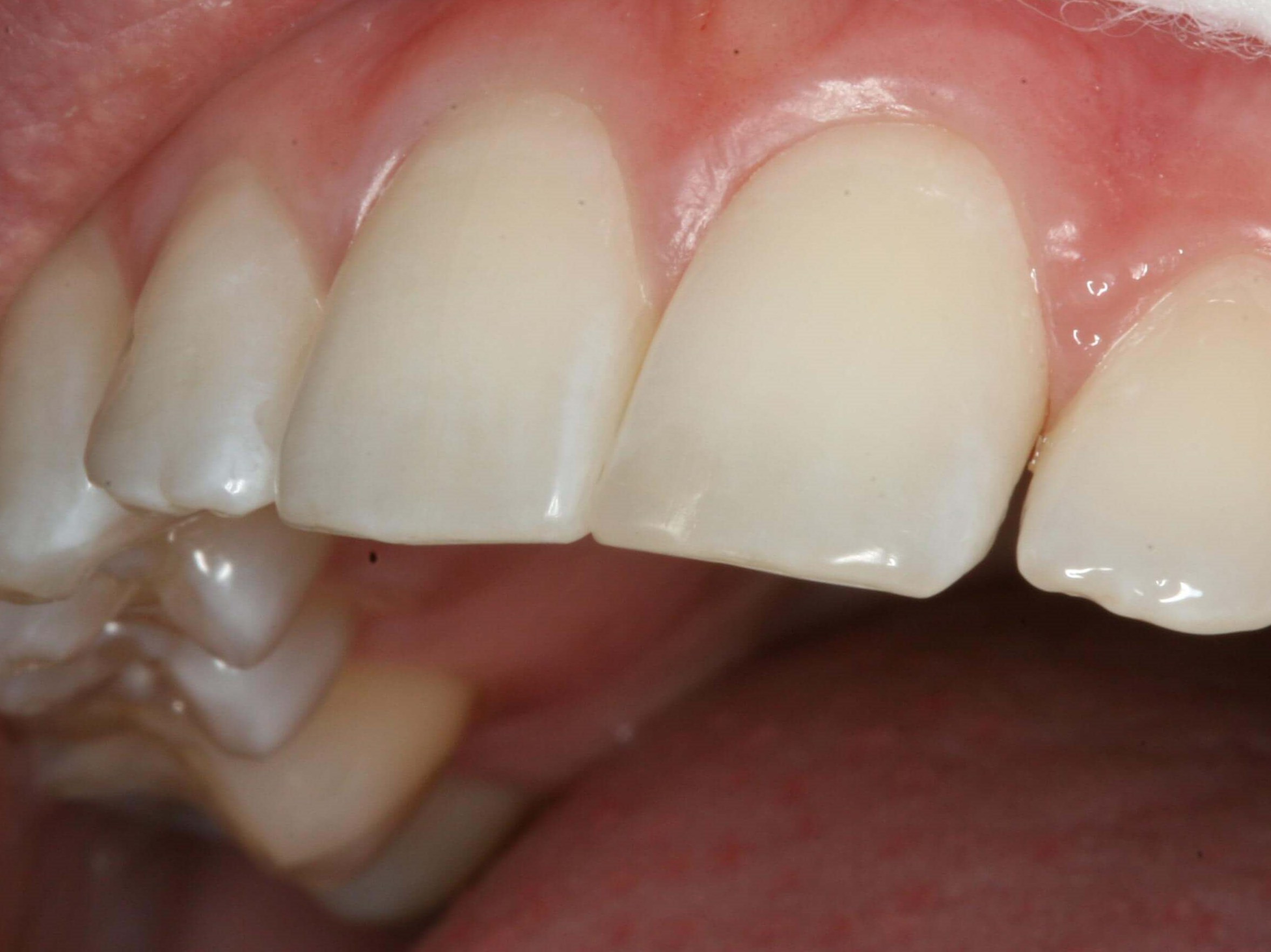Dental Bonding Before