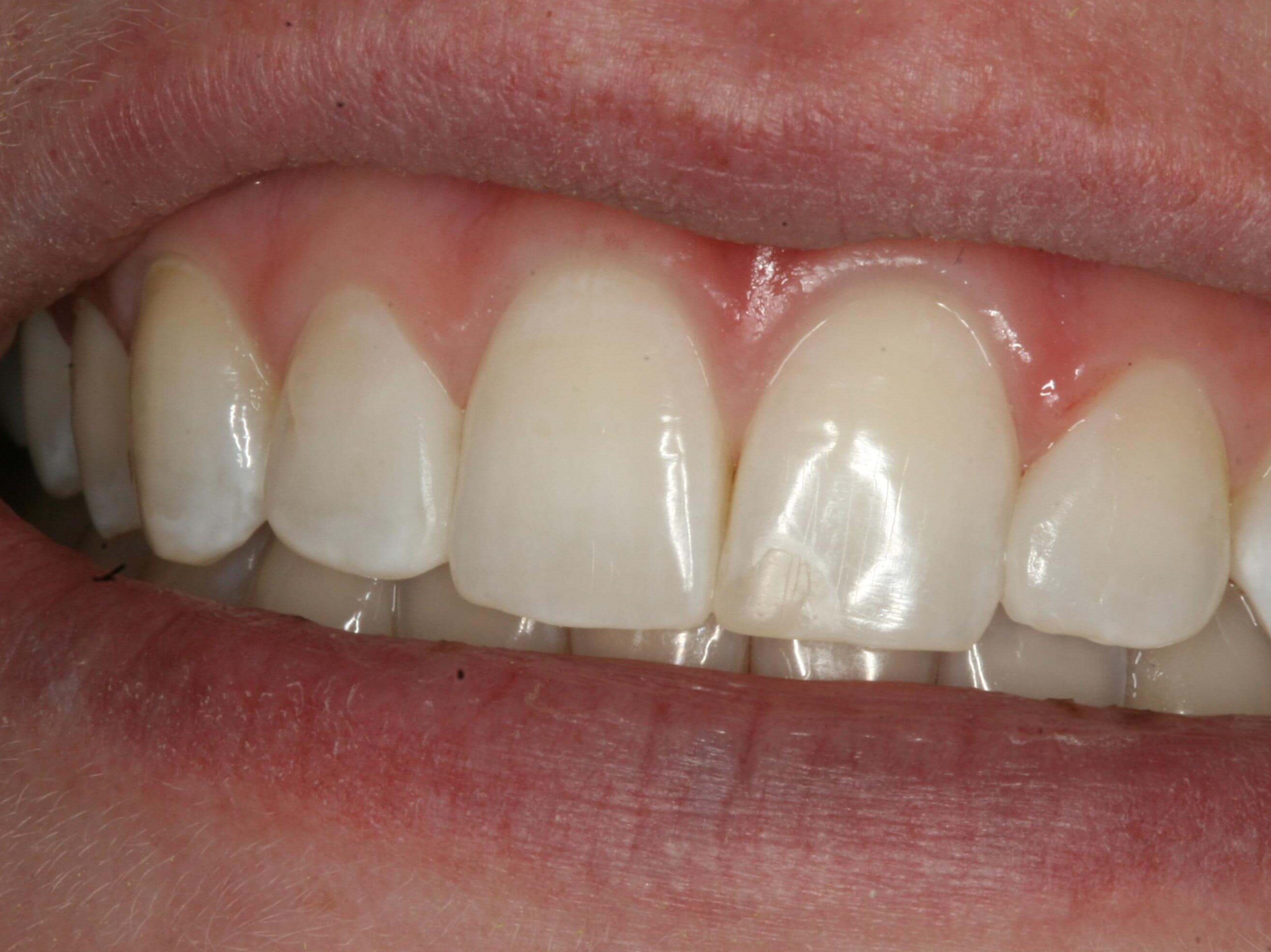 Dental Bonding After
