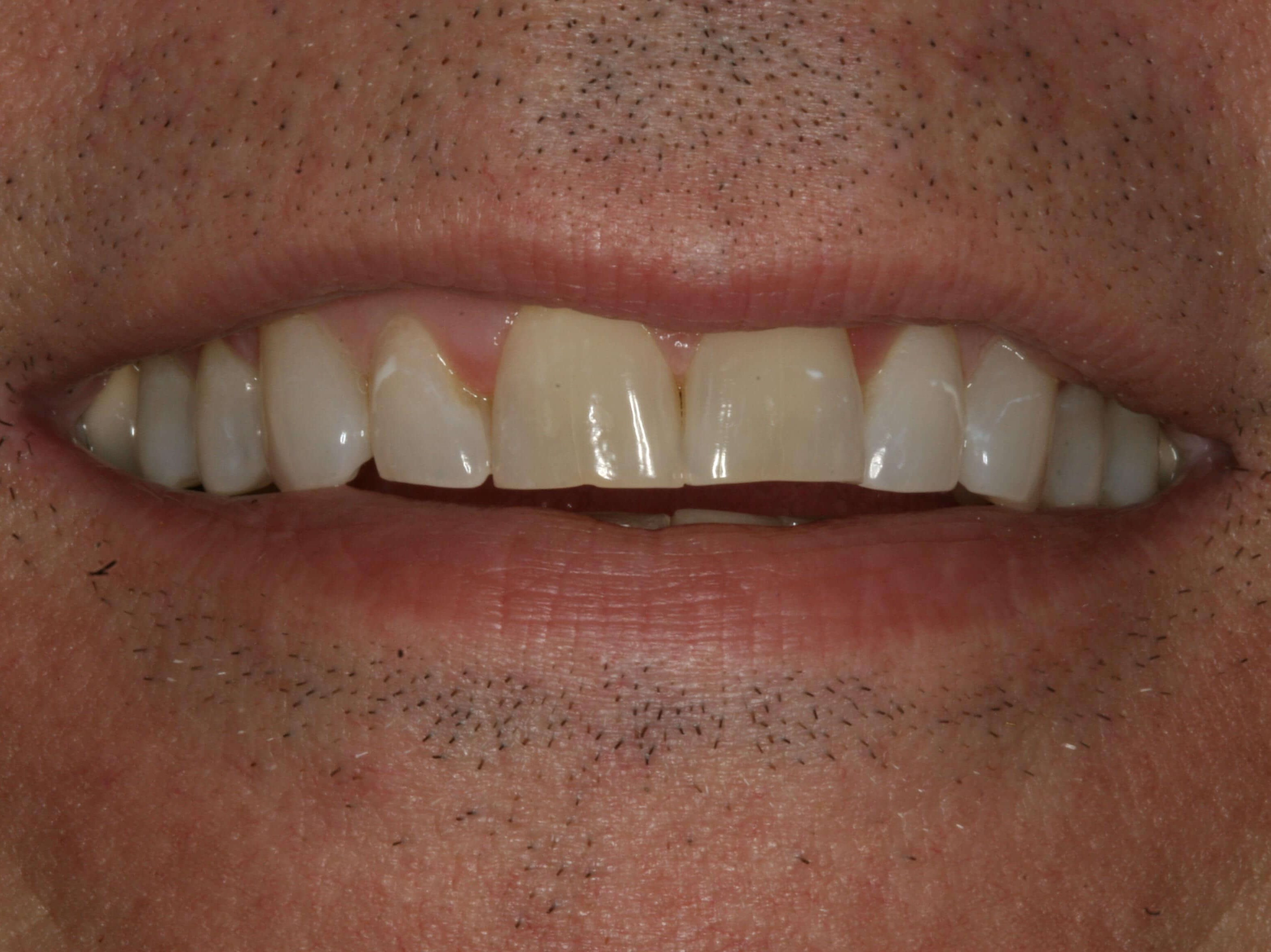 Worn Dentition Needs Makeover Before