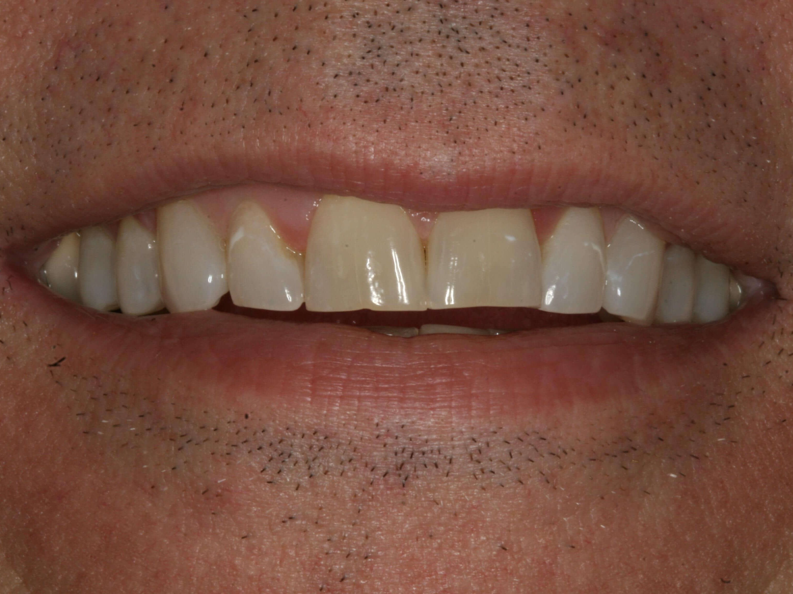 Before and After Comparison Before