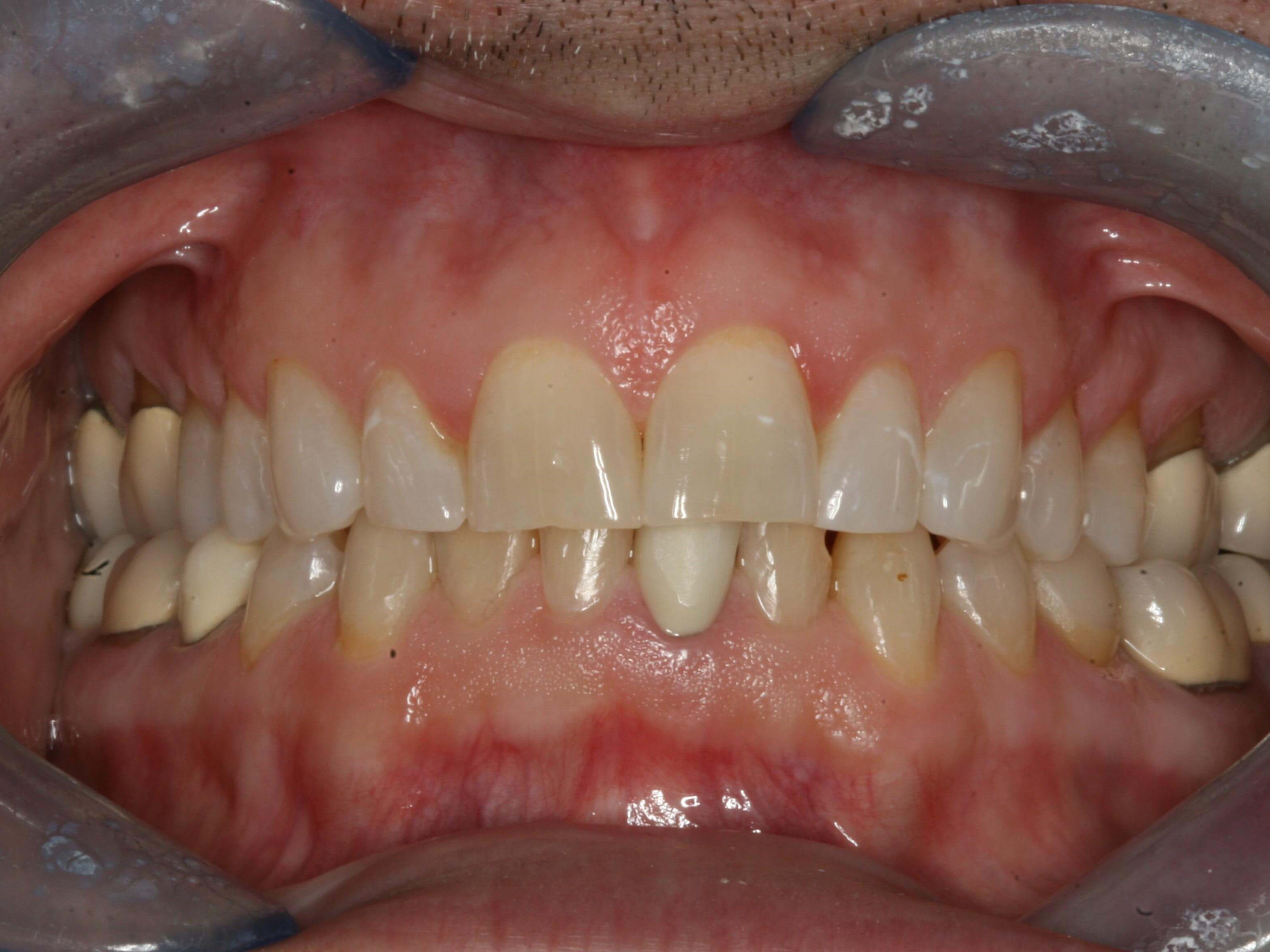 Before and After Retracted Before