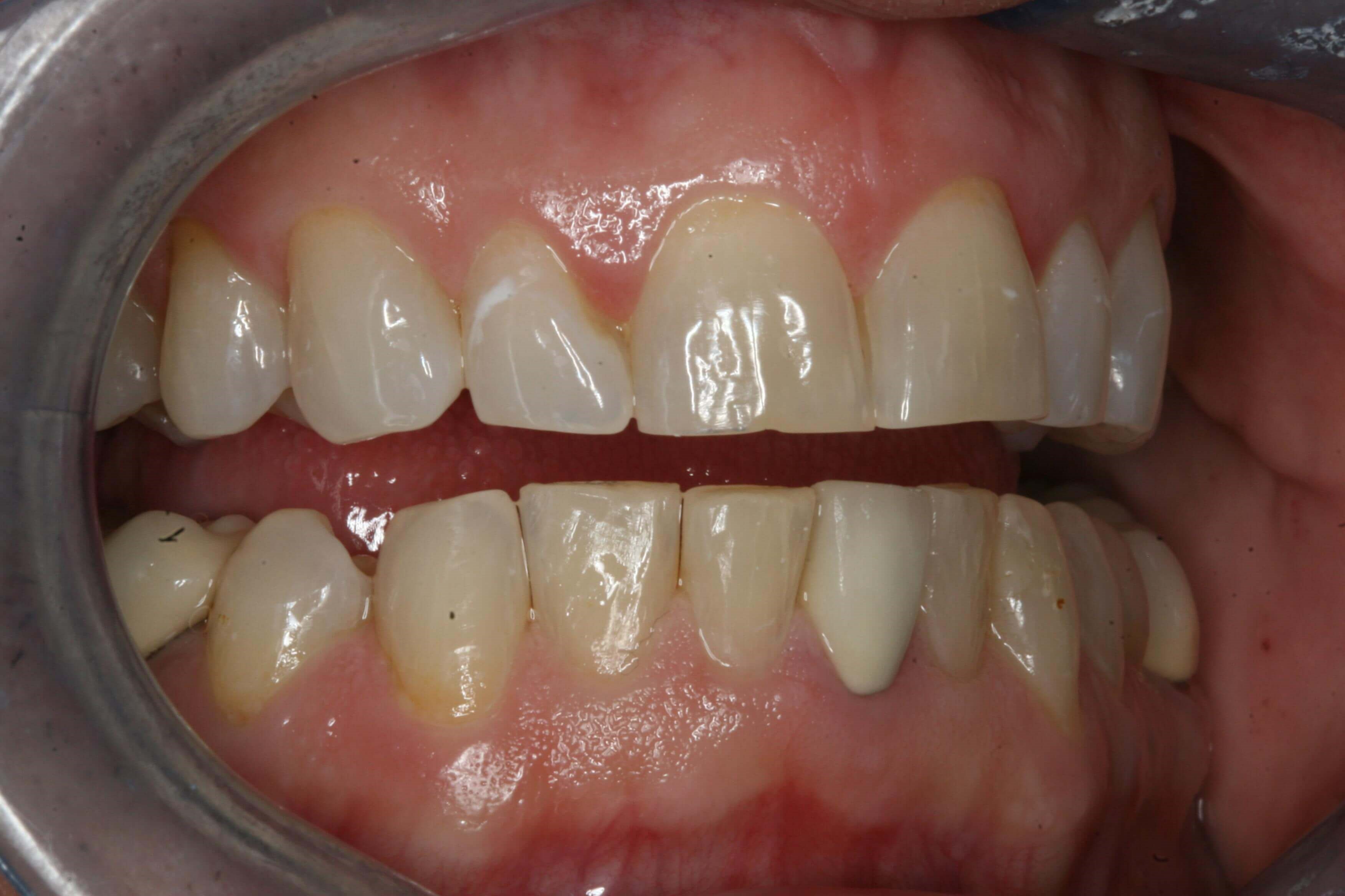 Before Right and Left Views Before Right