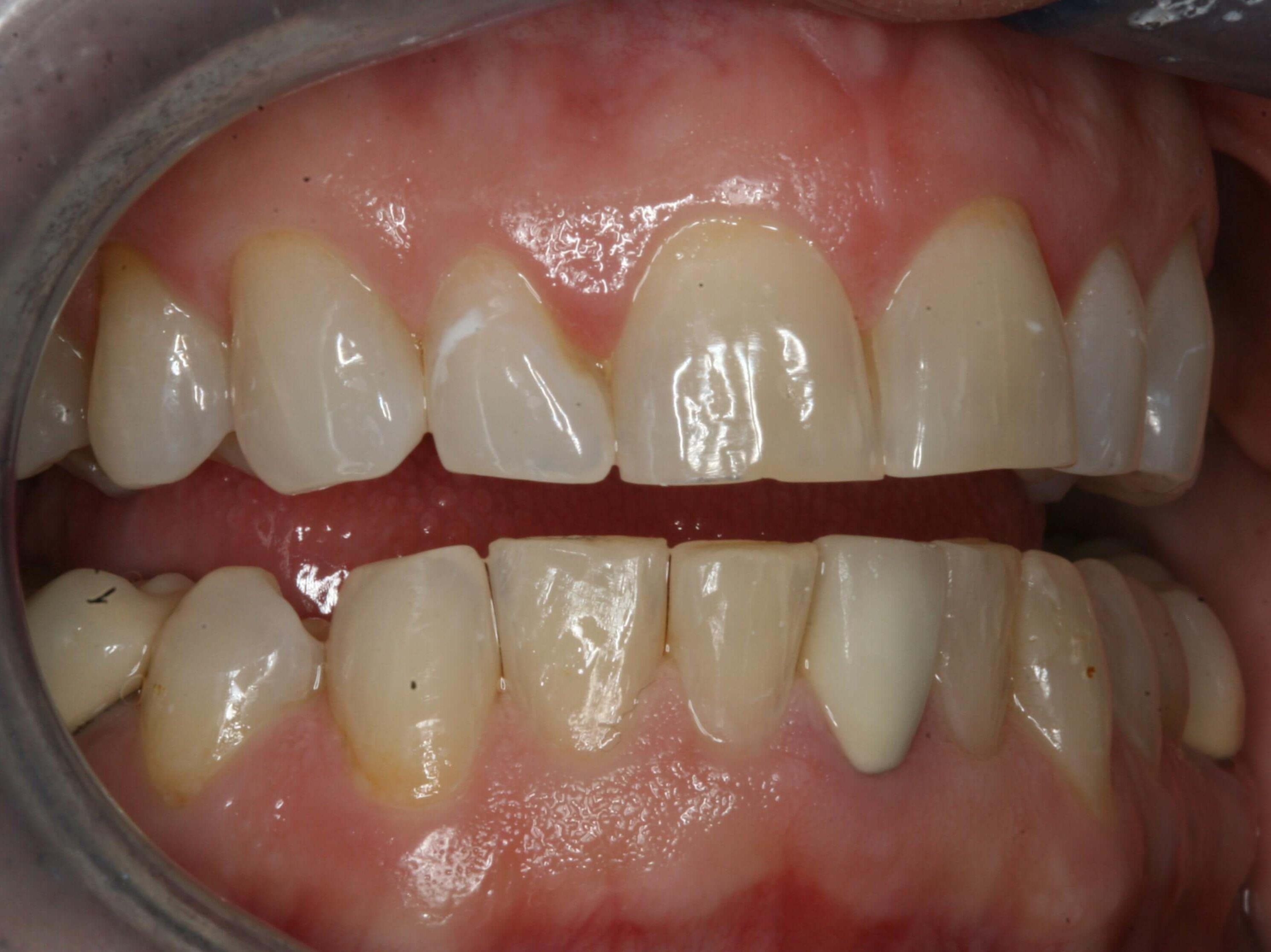 Before Right and Left Views Before Right