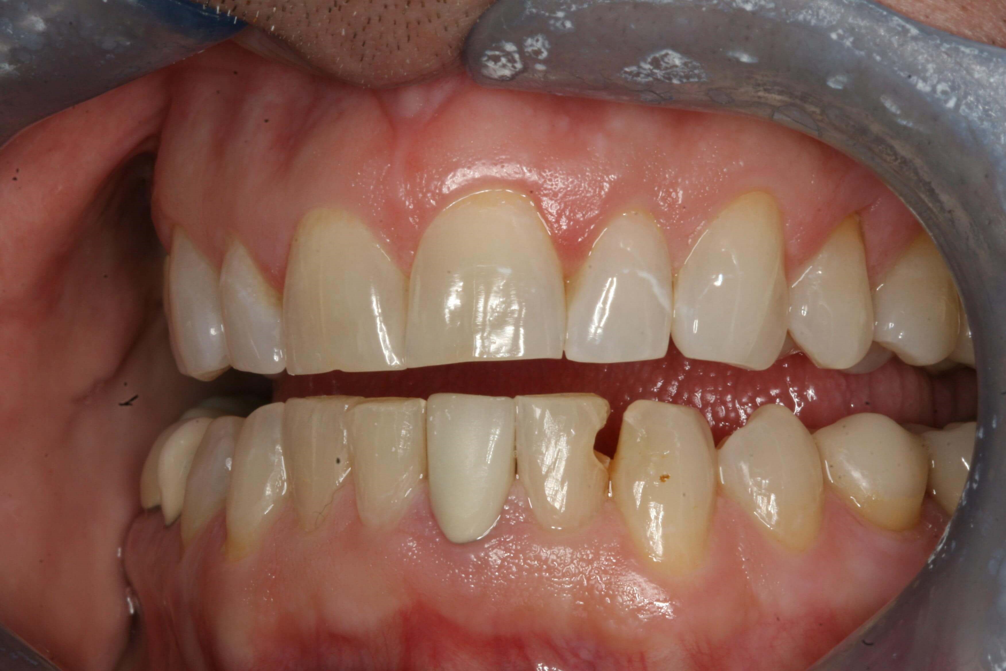 Before Right and Left Views Before Left