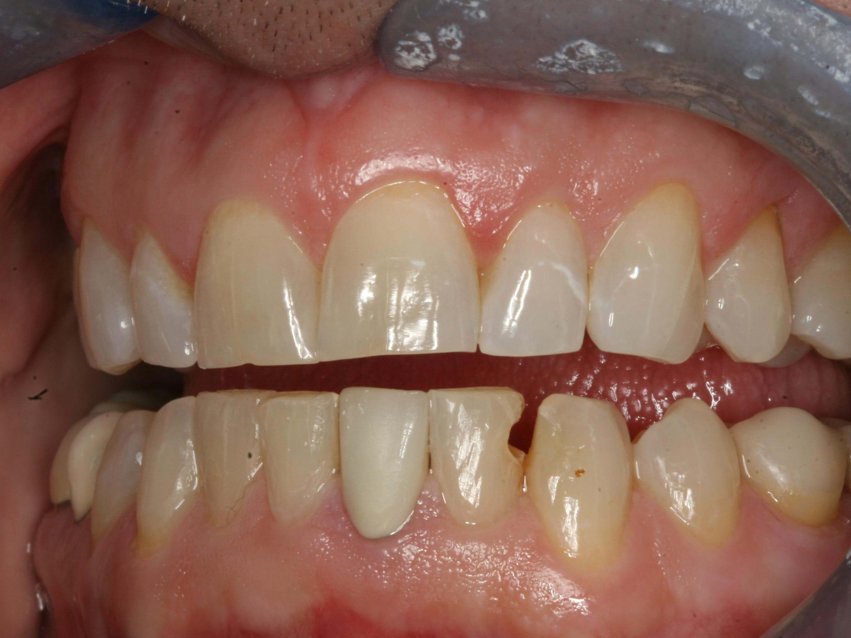 Before Right and Left Views Before Left