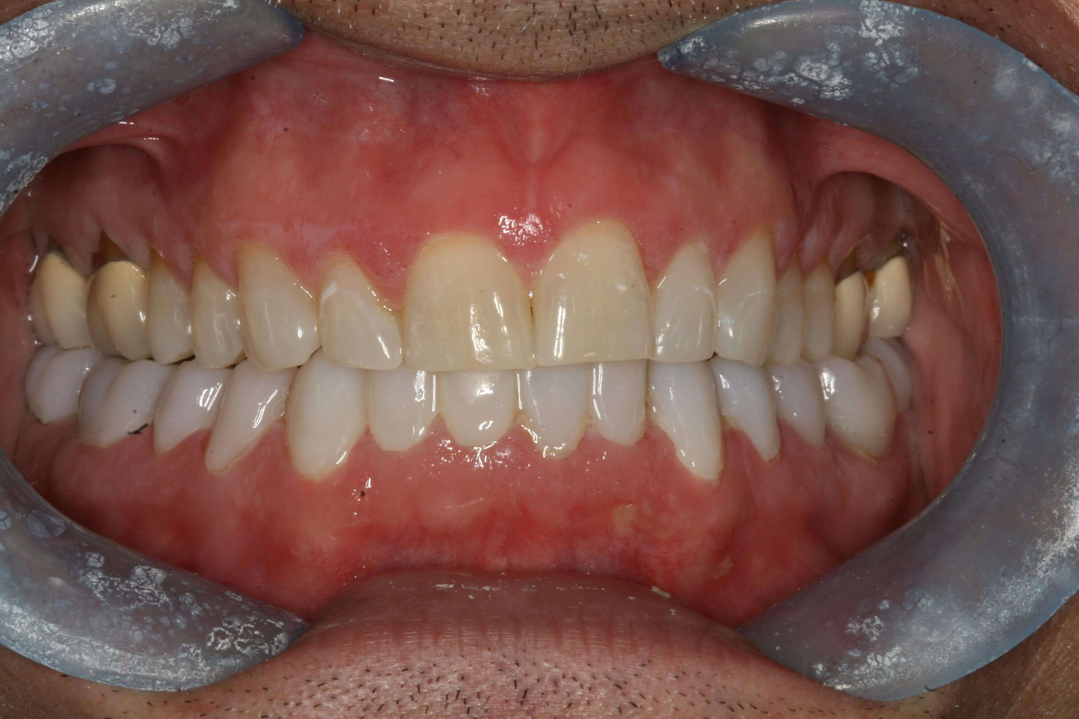 Provisional Photos Temporaries Lower