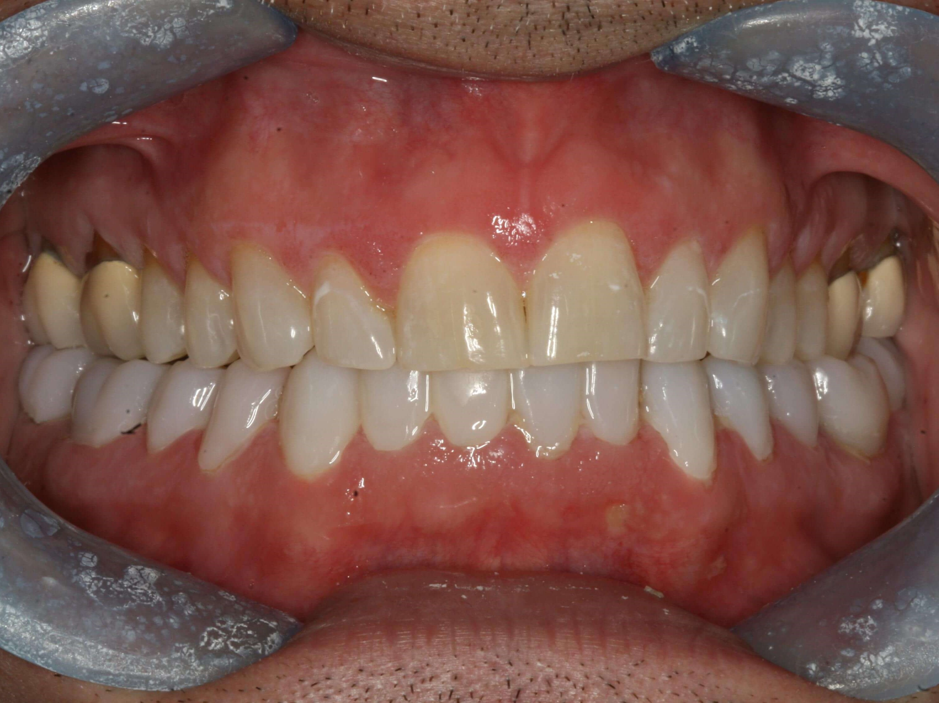 Provisional Photos Temporaries Lower