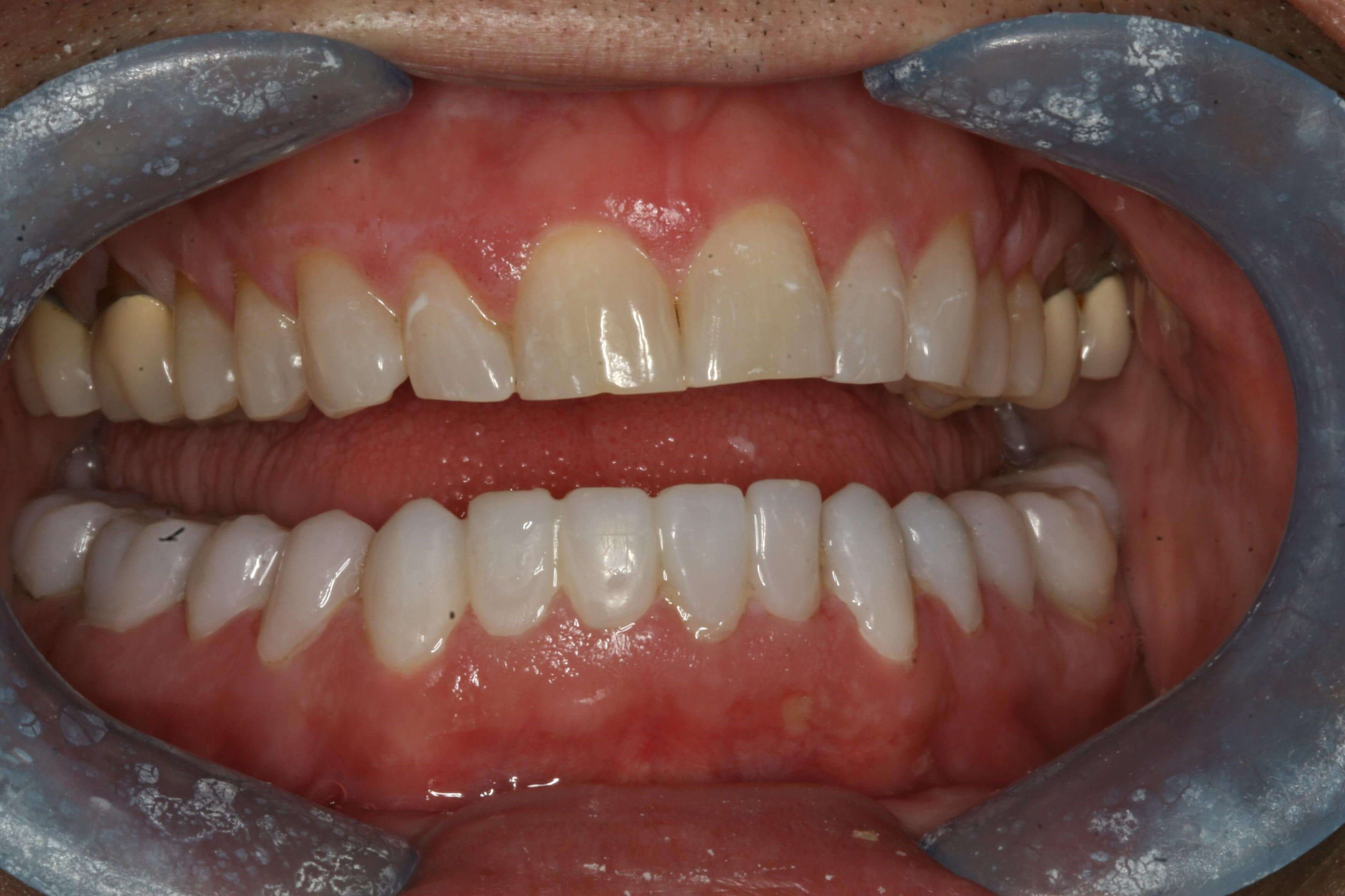 Provisional Photos Temporaries Lower