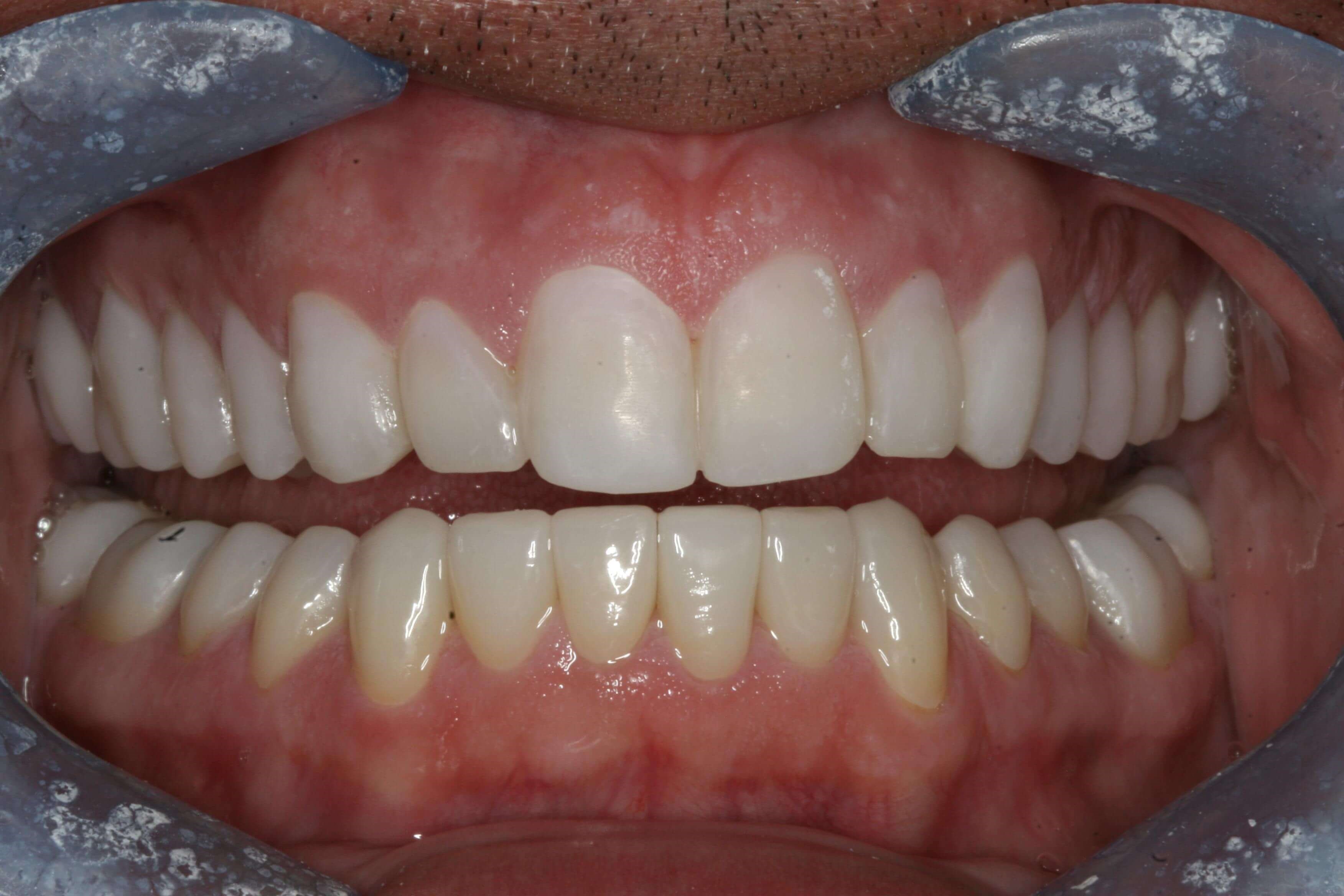 Next Step Uppers Temporary Upper