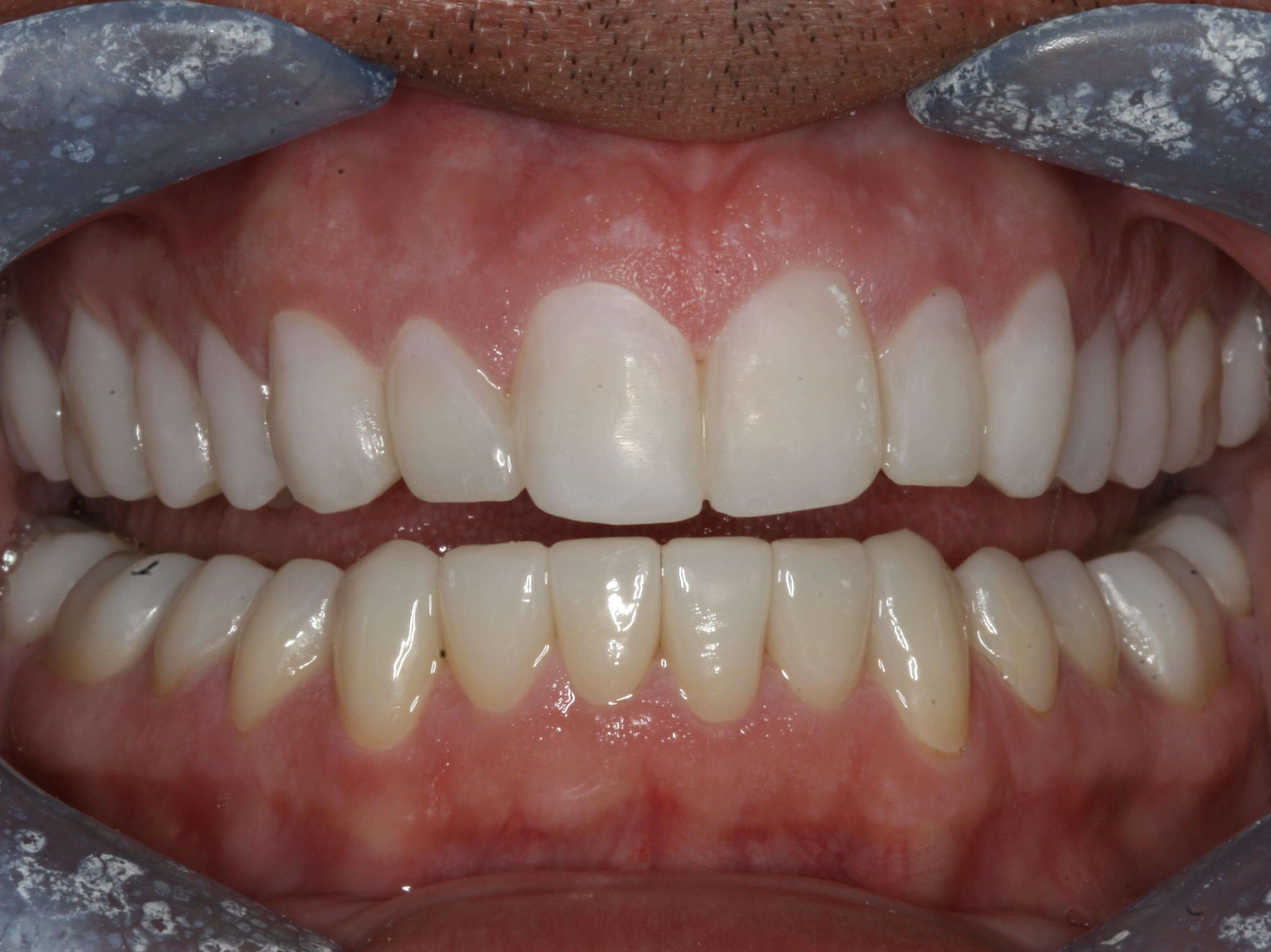 Next Step Uppers Temporary Upper