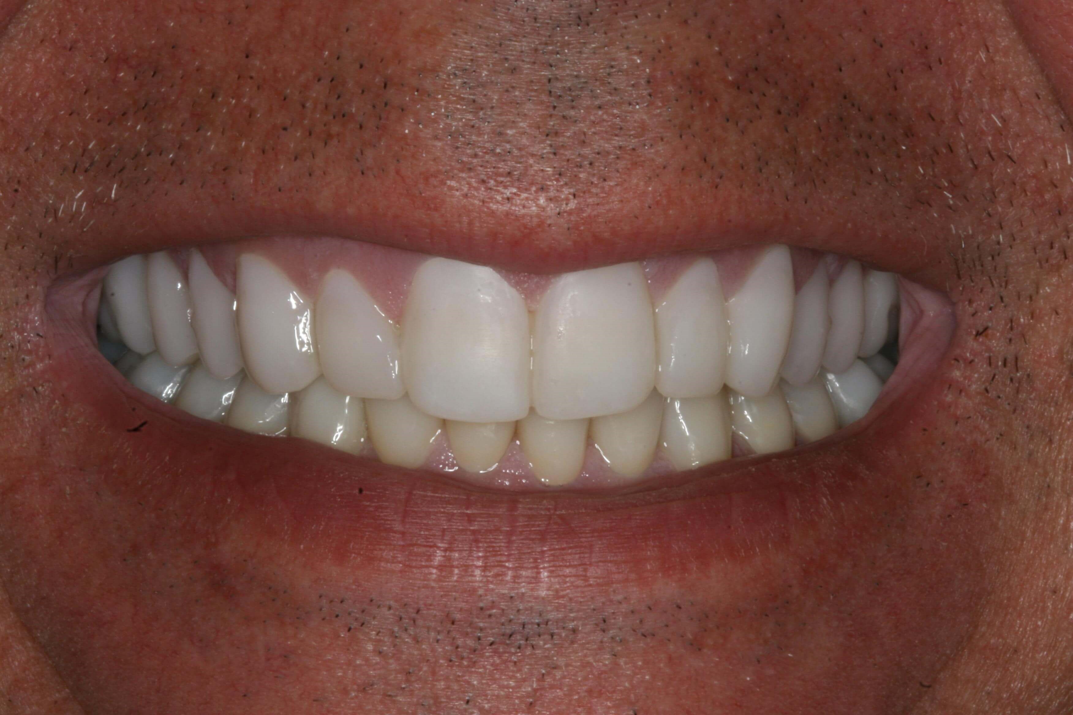 Next Step Uppers Temporary Upper