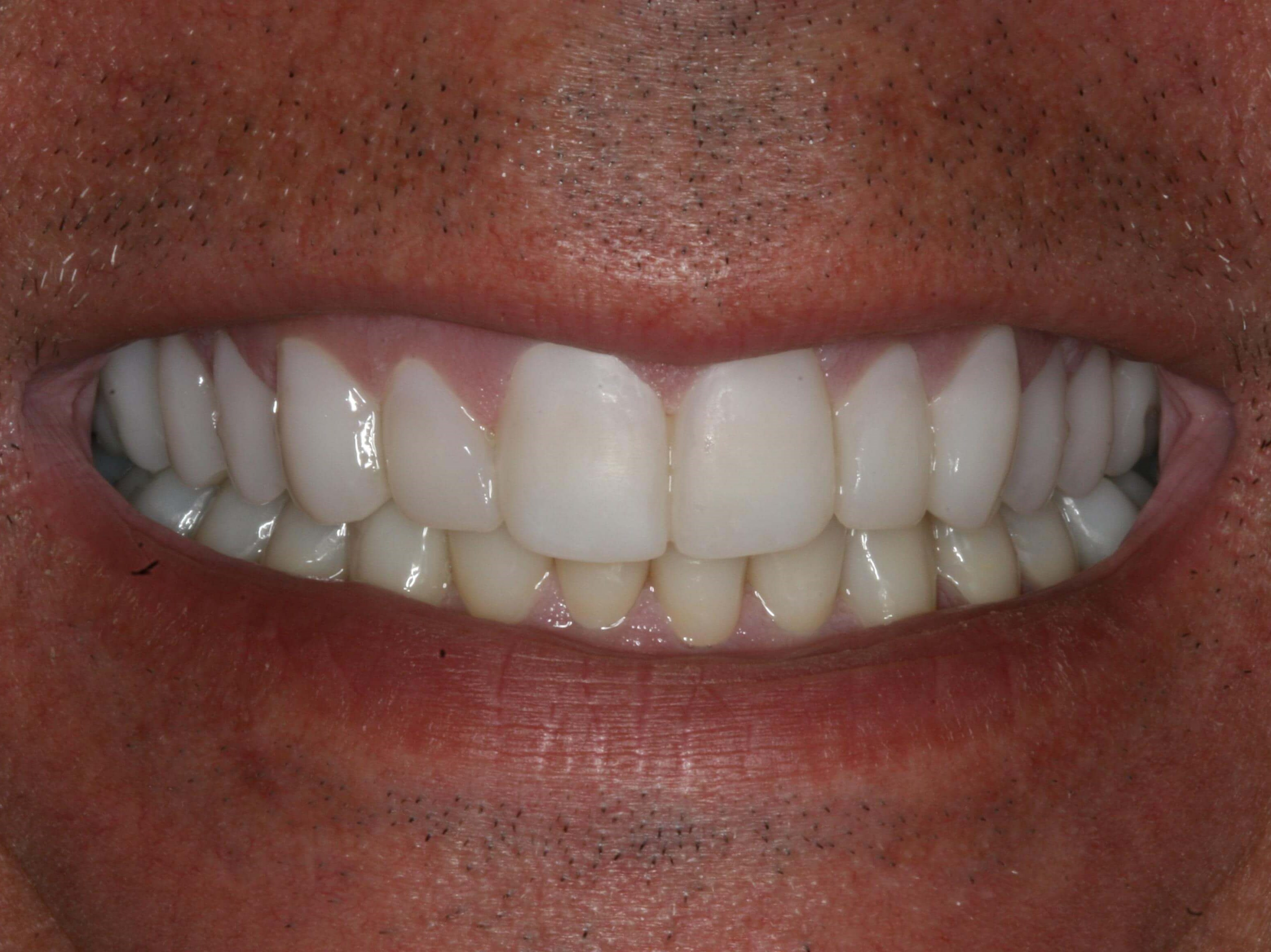 Next Step Uppers Temporary Upper