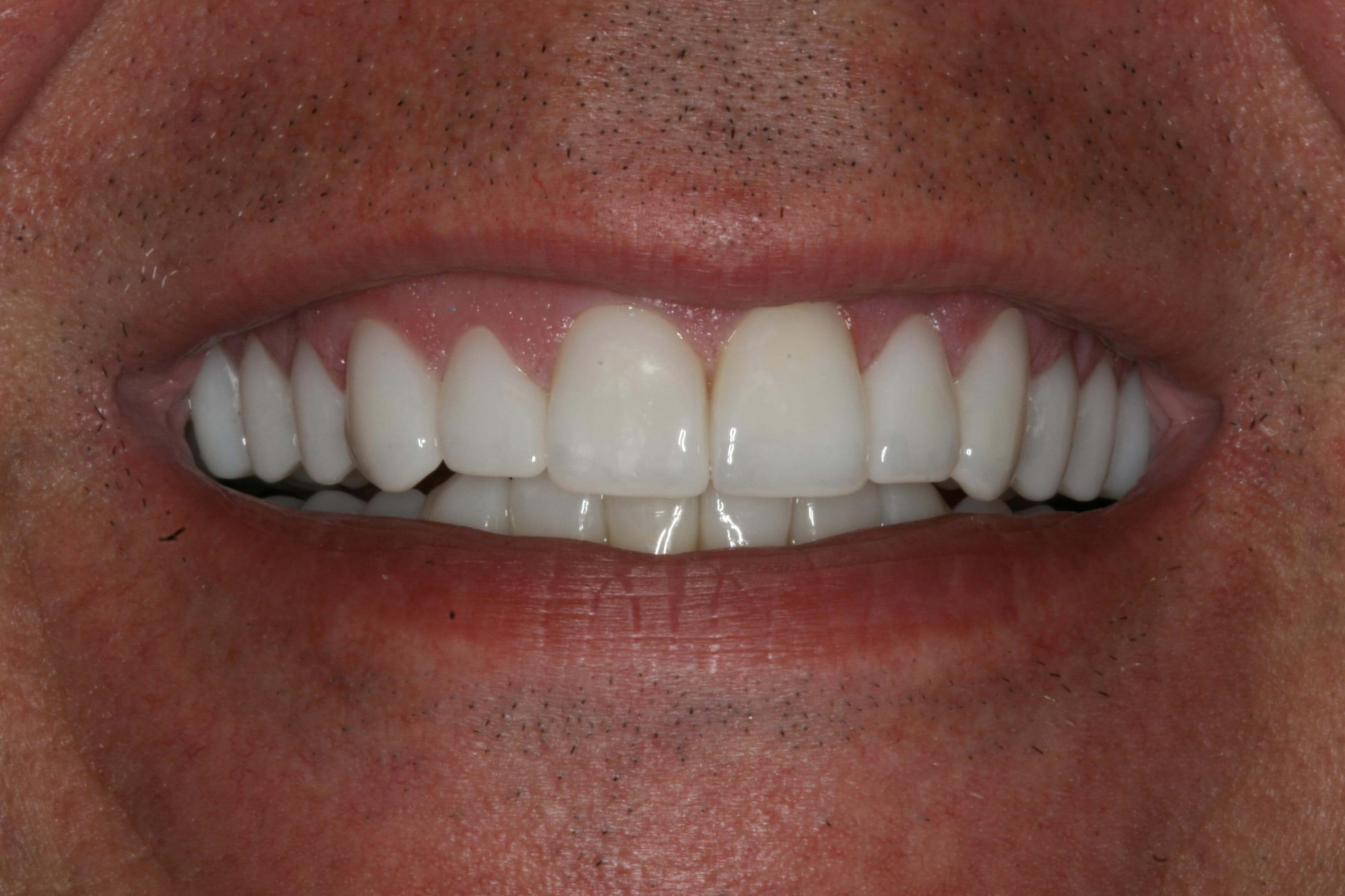 Final More Youthful Smile Final Smile