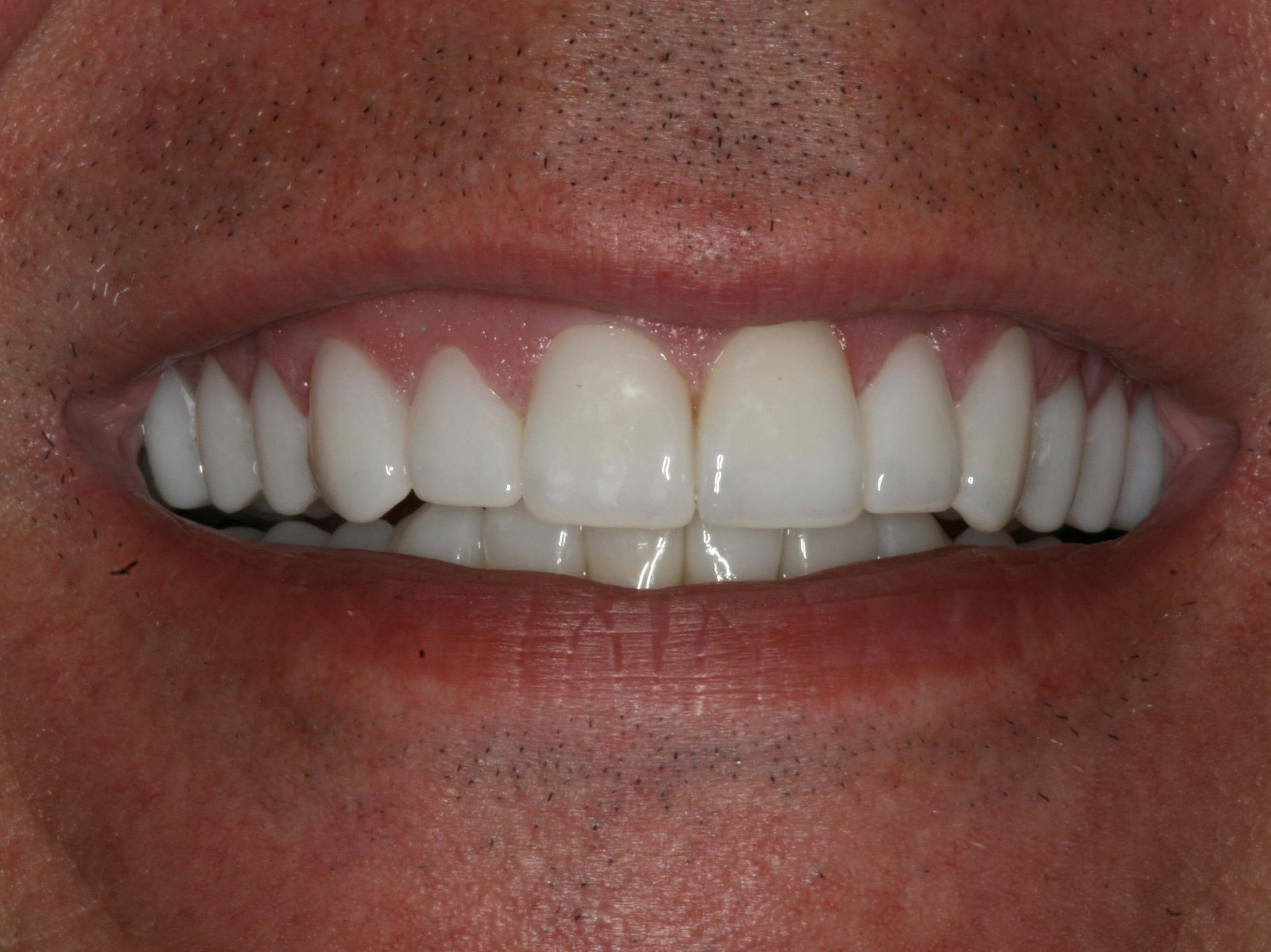 Final More Youthful Smile Final Smile