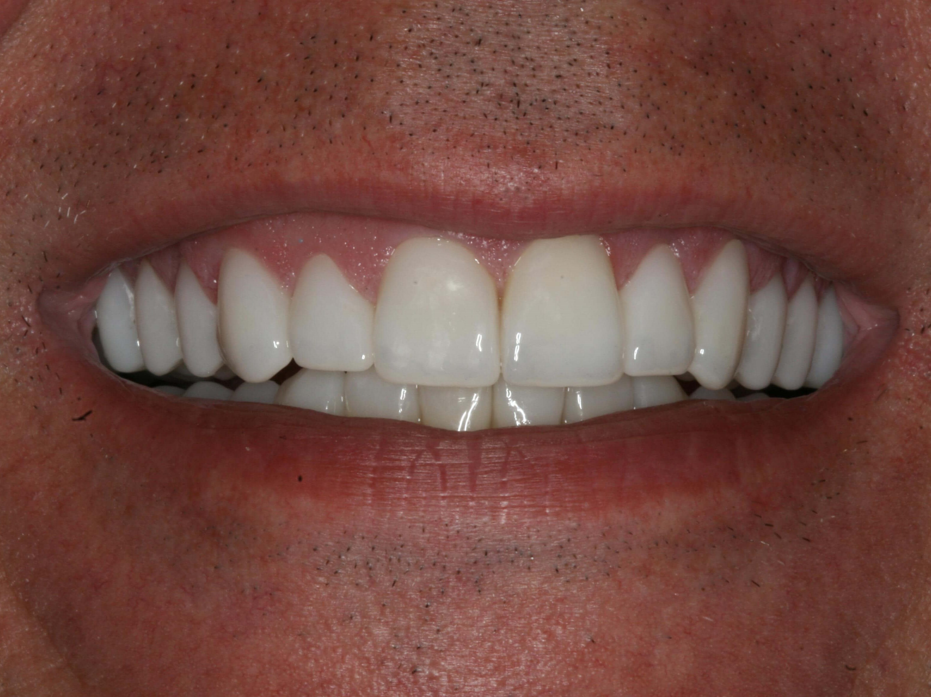 Before and After Comparison After