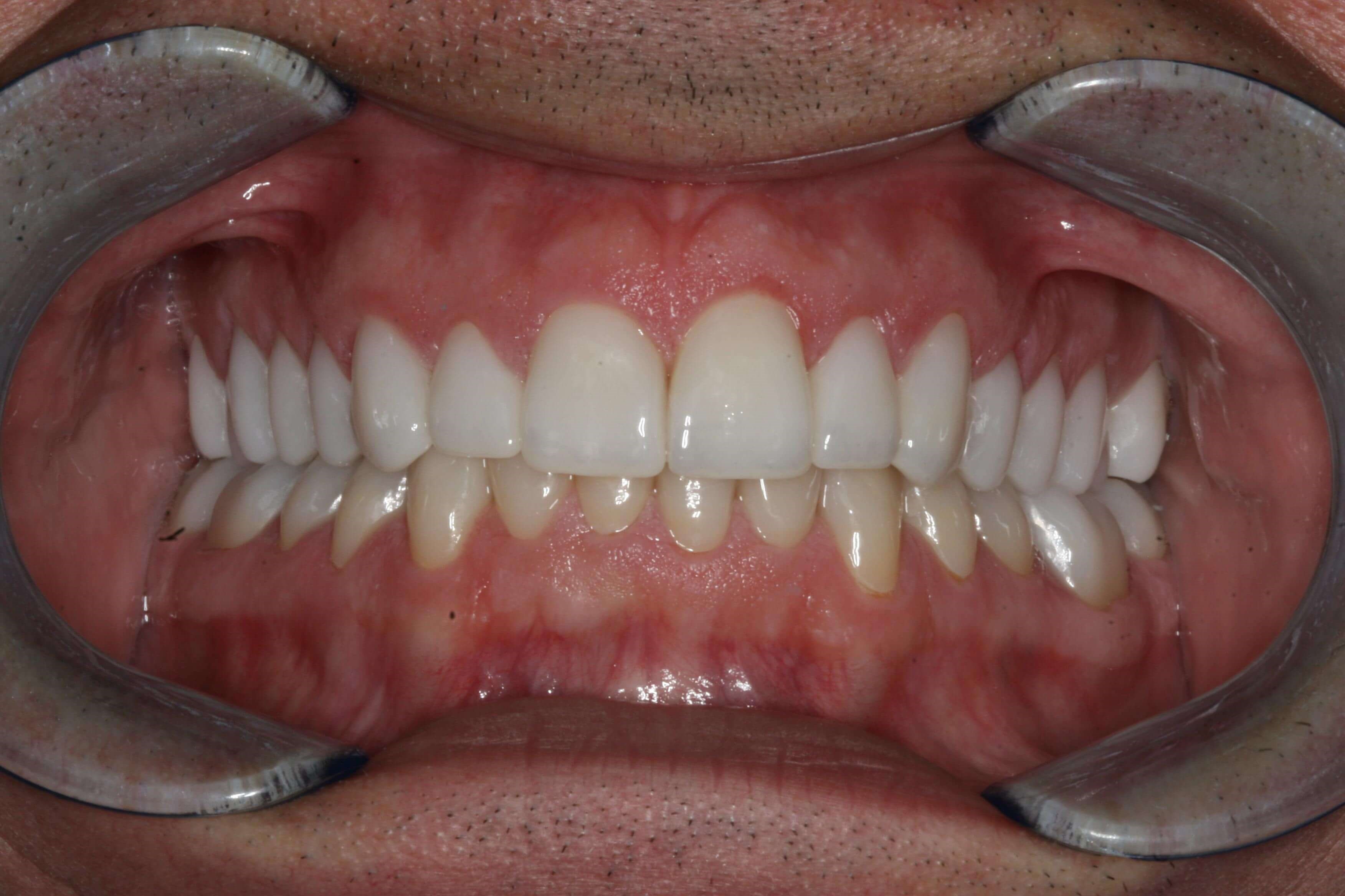 Final More Youthful Smile Final Retracted Biting