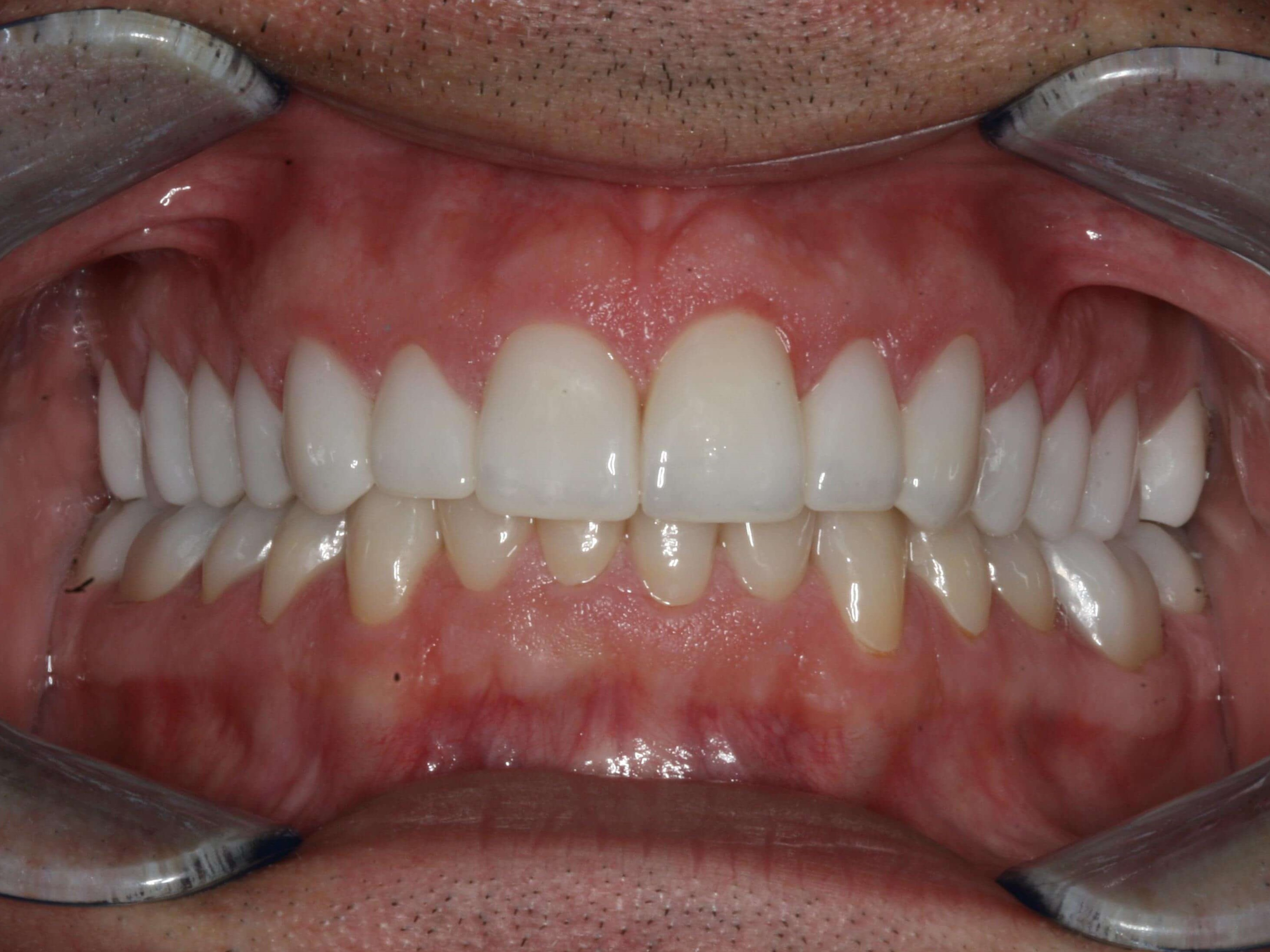 Final More Youthful Smile Final Retracted Biting