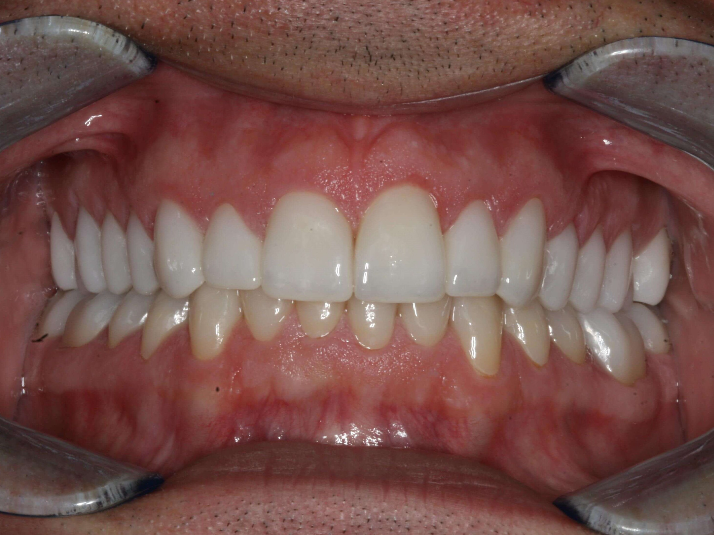 Before and After Retracted After