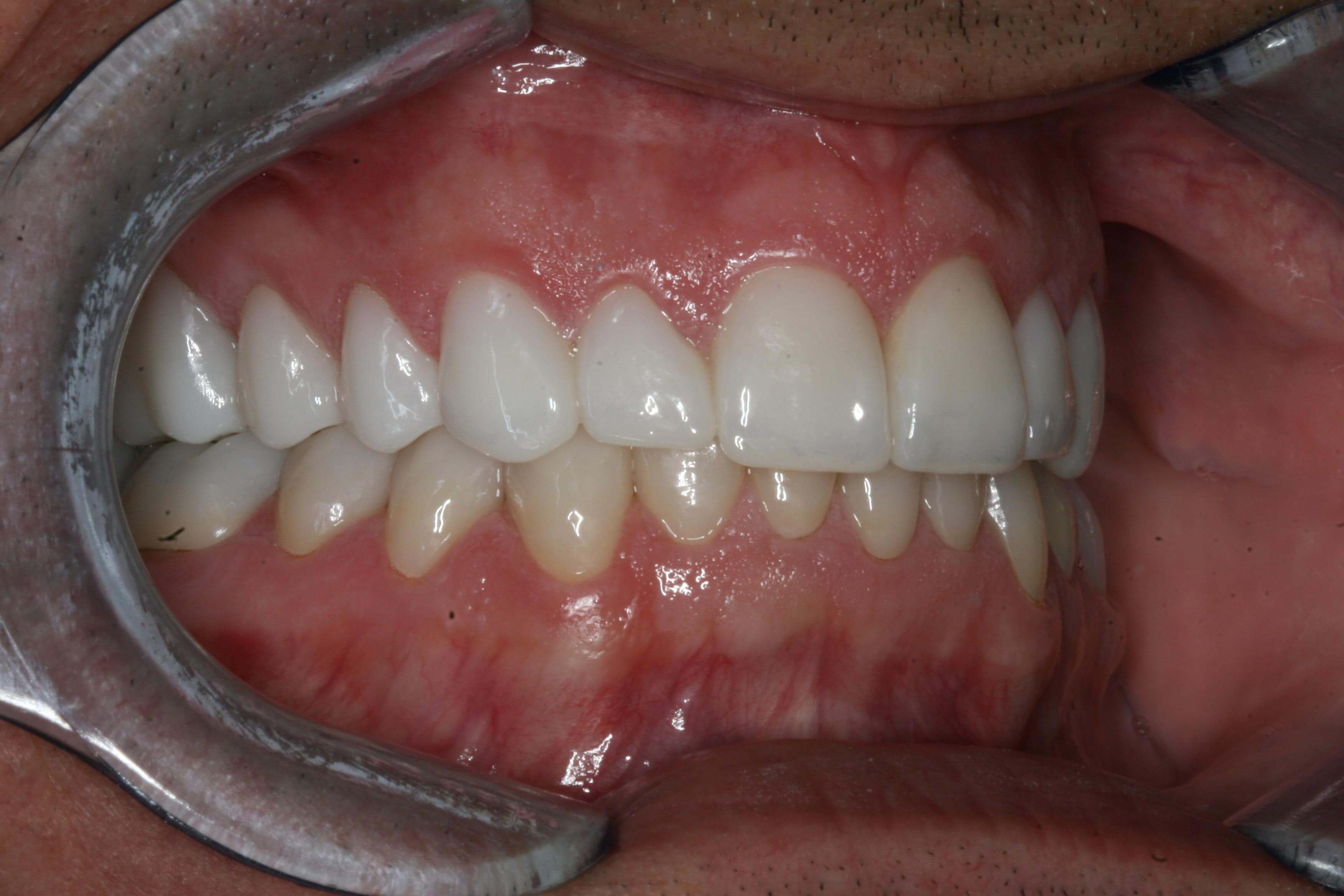 Final Right and Left Views After Right