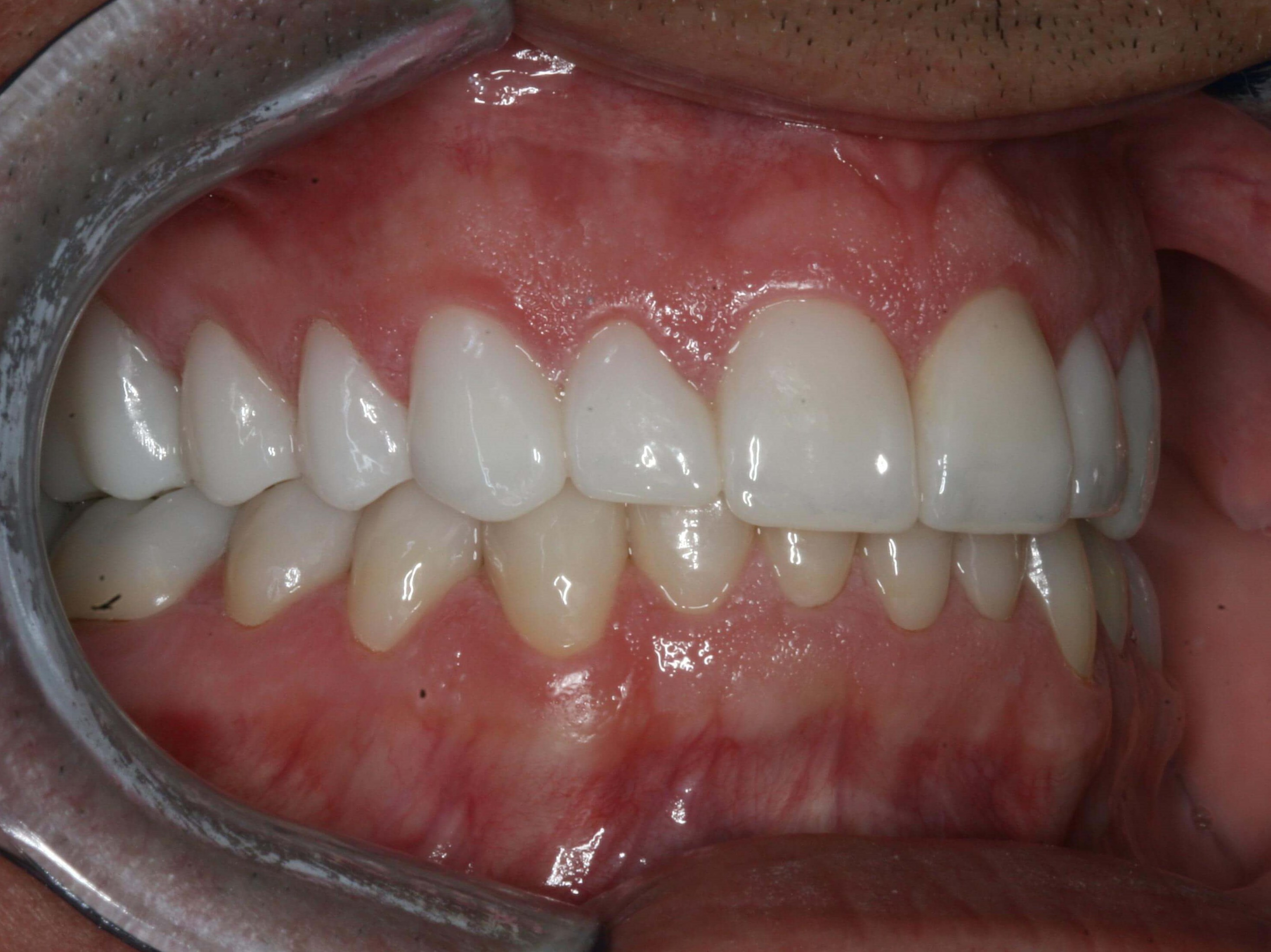 Final Right and Left Views After Right