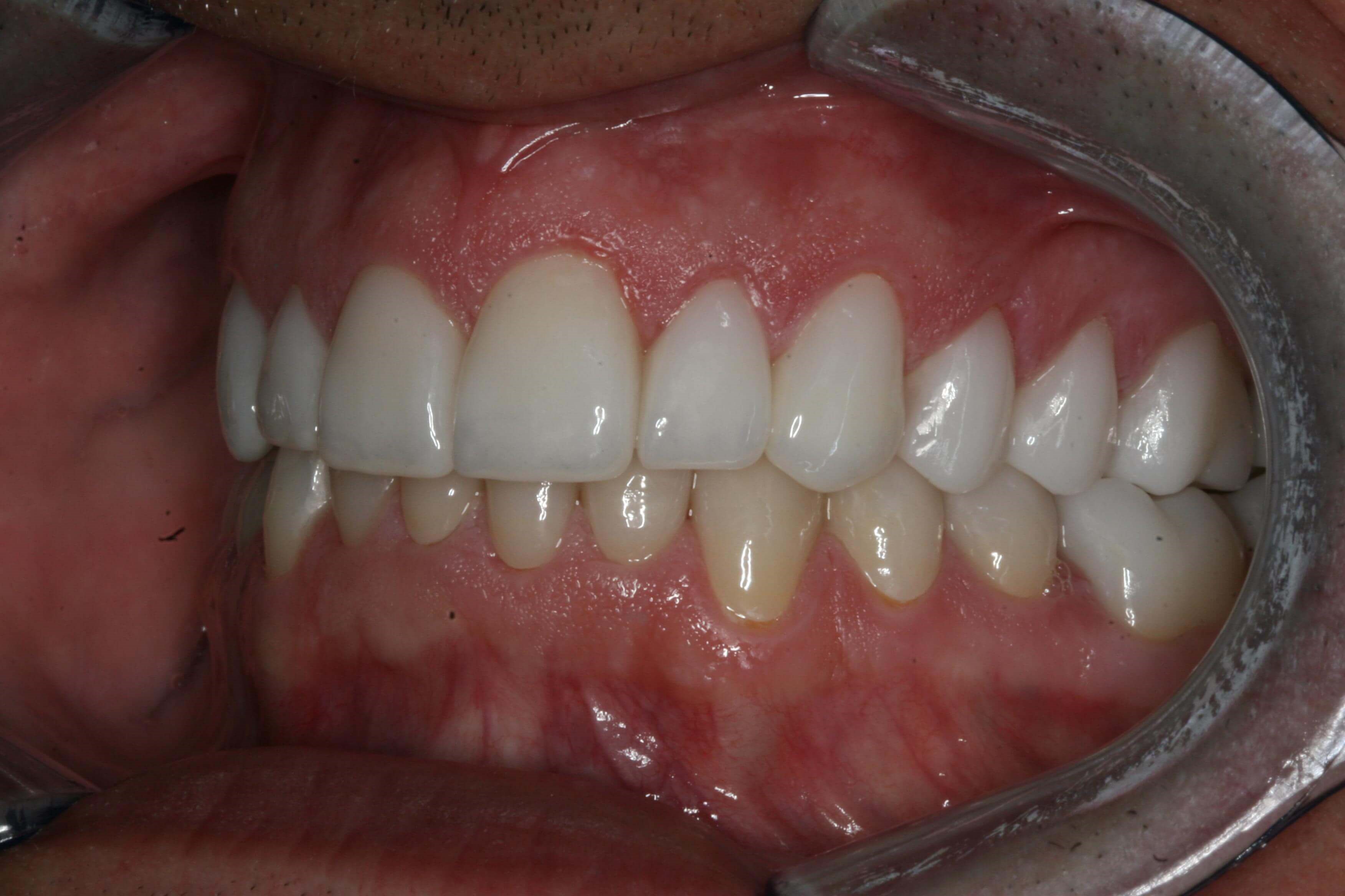 Final Right and Left Views After Left