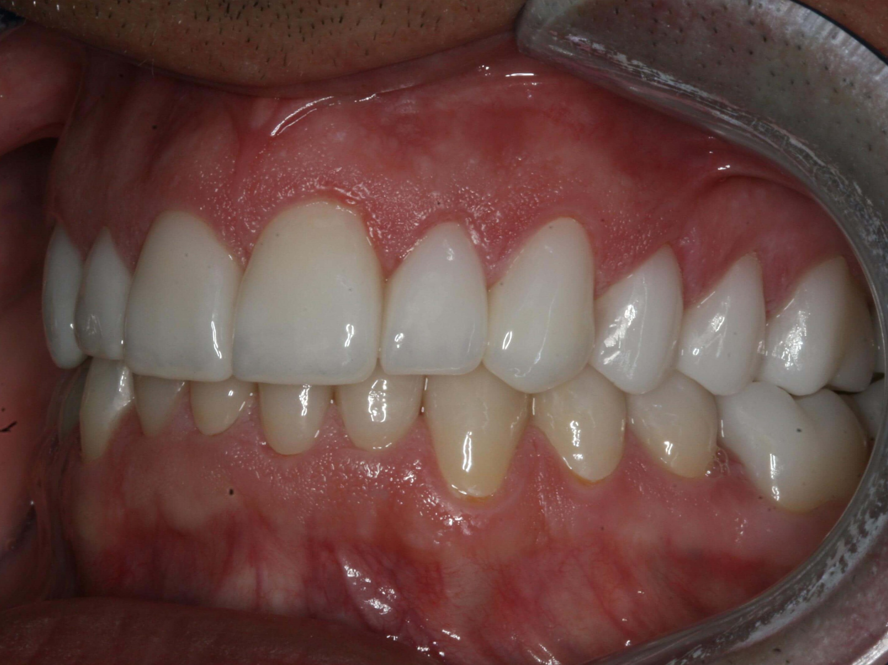 Final Right and Left Views After Left