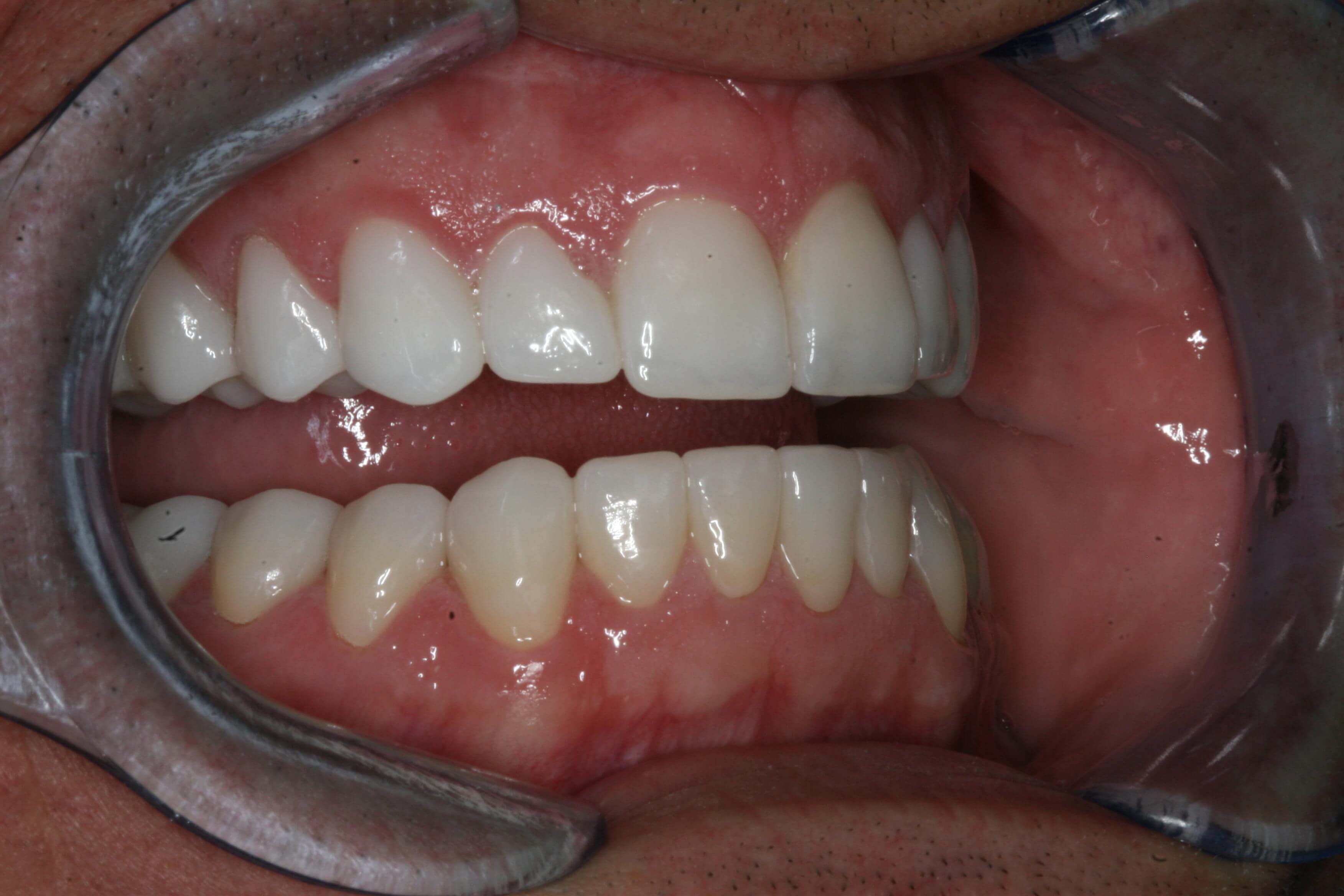 Right and Left Retracted Final After Right