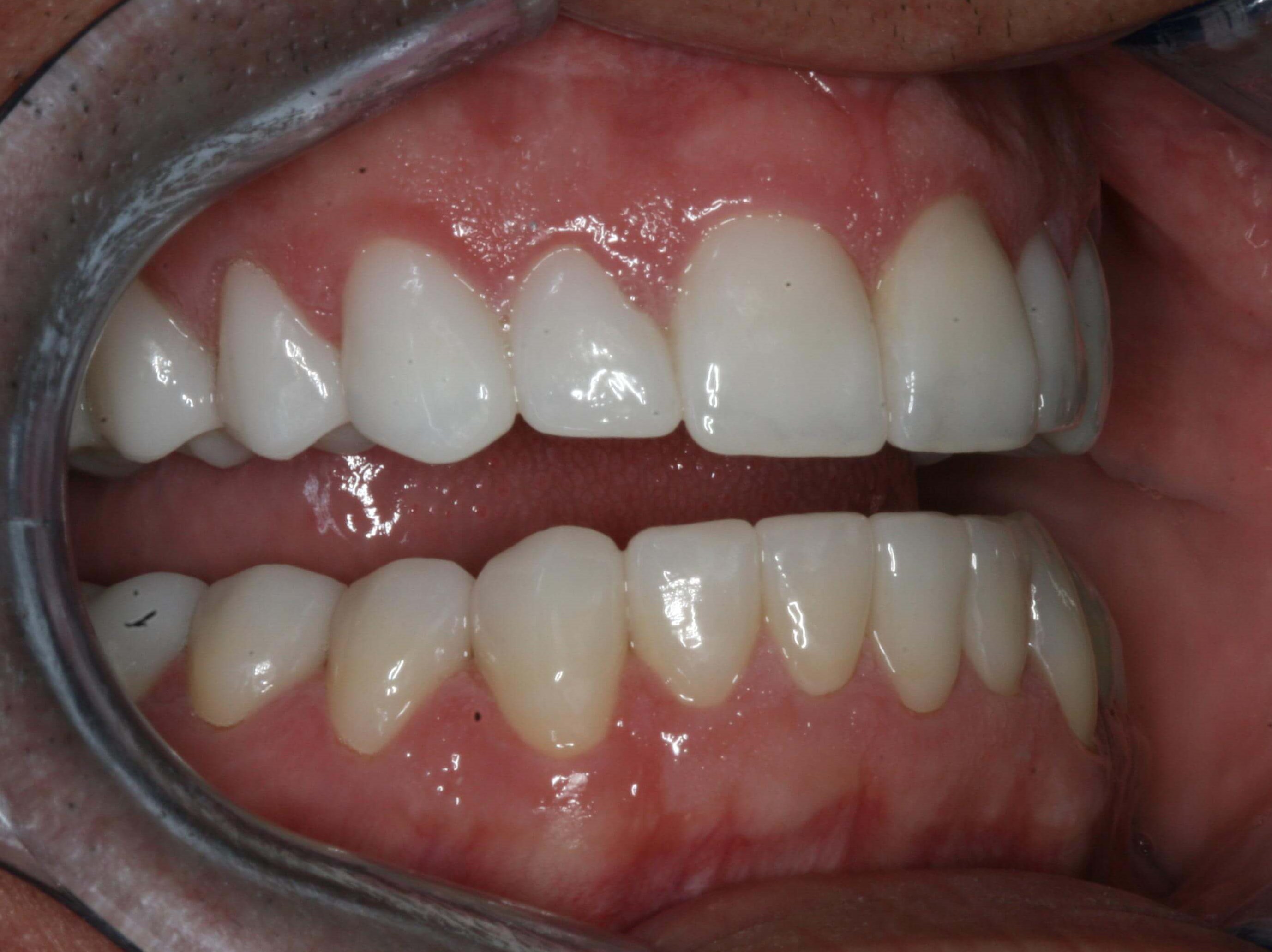 Right and Left Retracted Final After Right