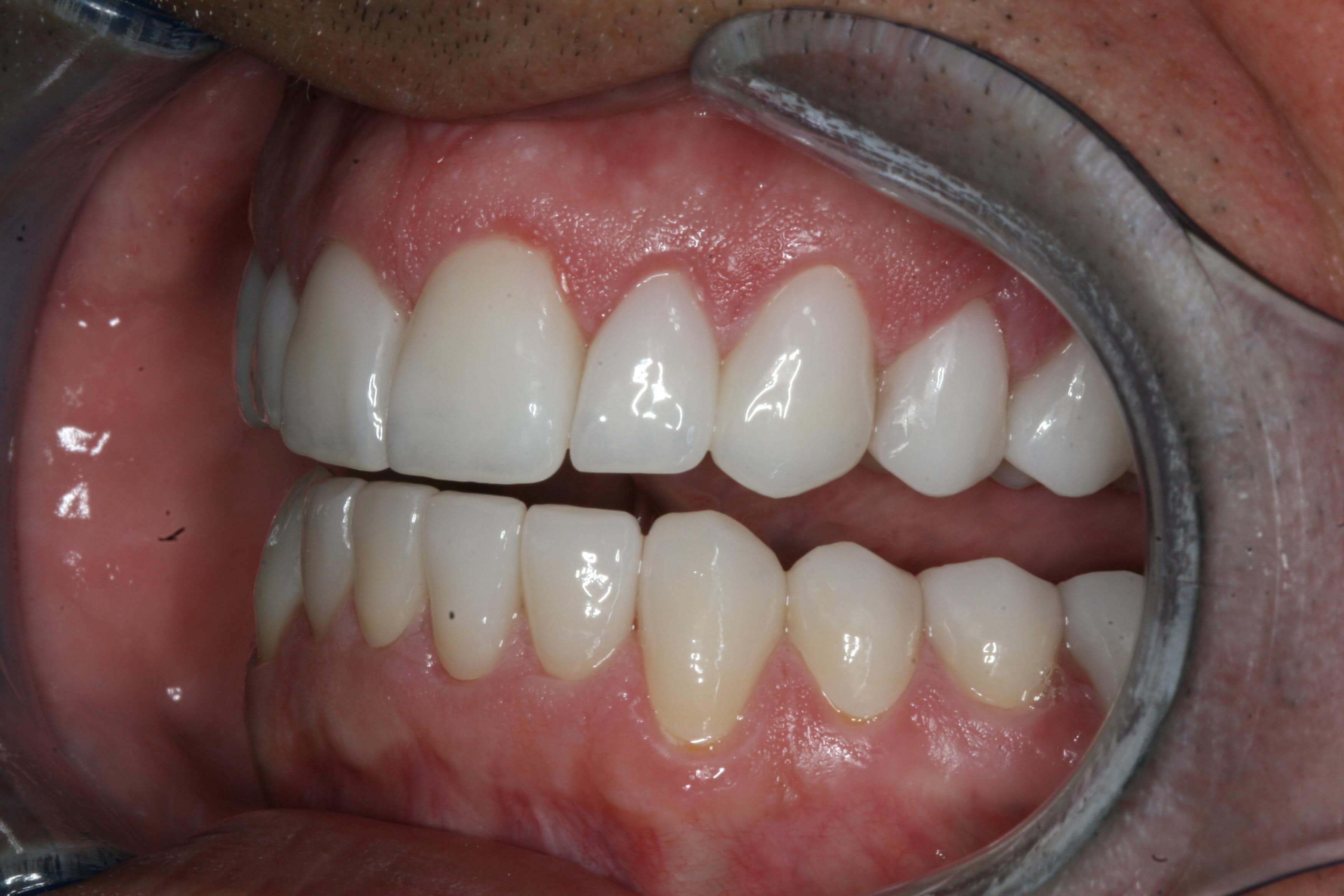 Right and Left Retracted Final After Left