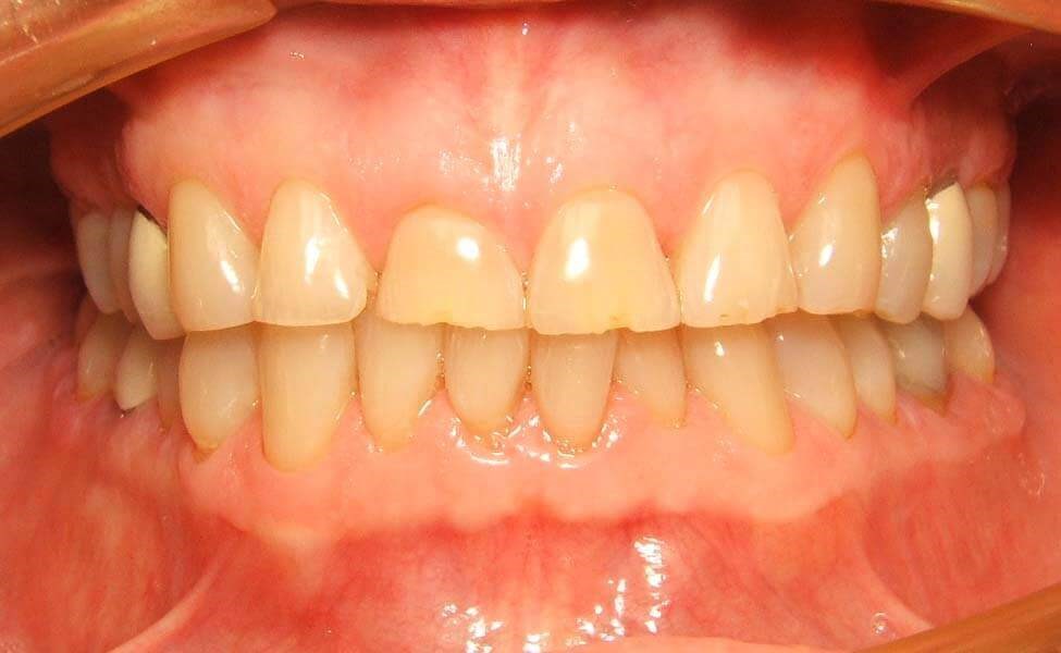 Worn Teeth Need Repair Before