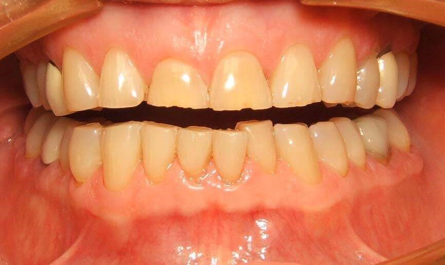 Worn Teeth Need Repair Before