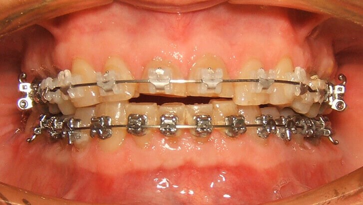 Braces To Help Final Result Braces Applied