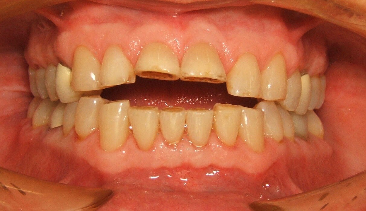 Braces To Help Final Result Braces Removed