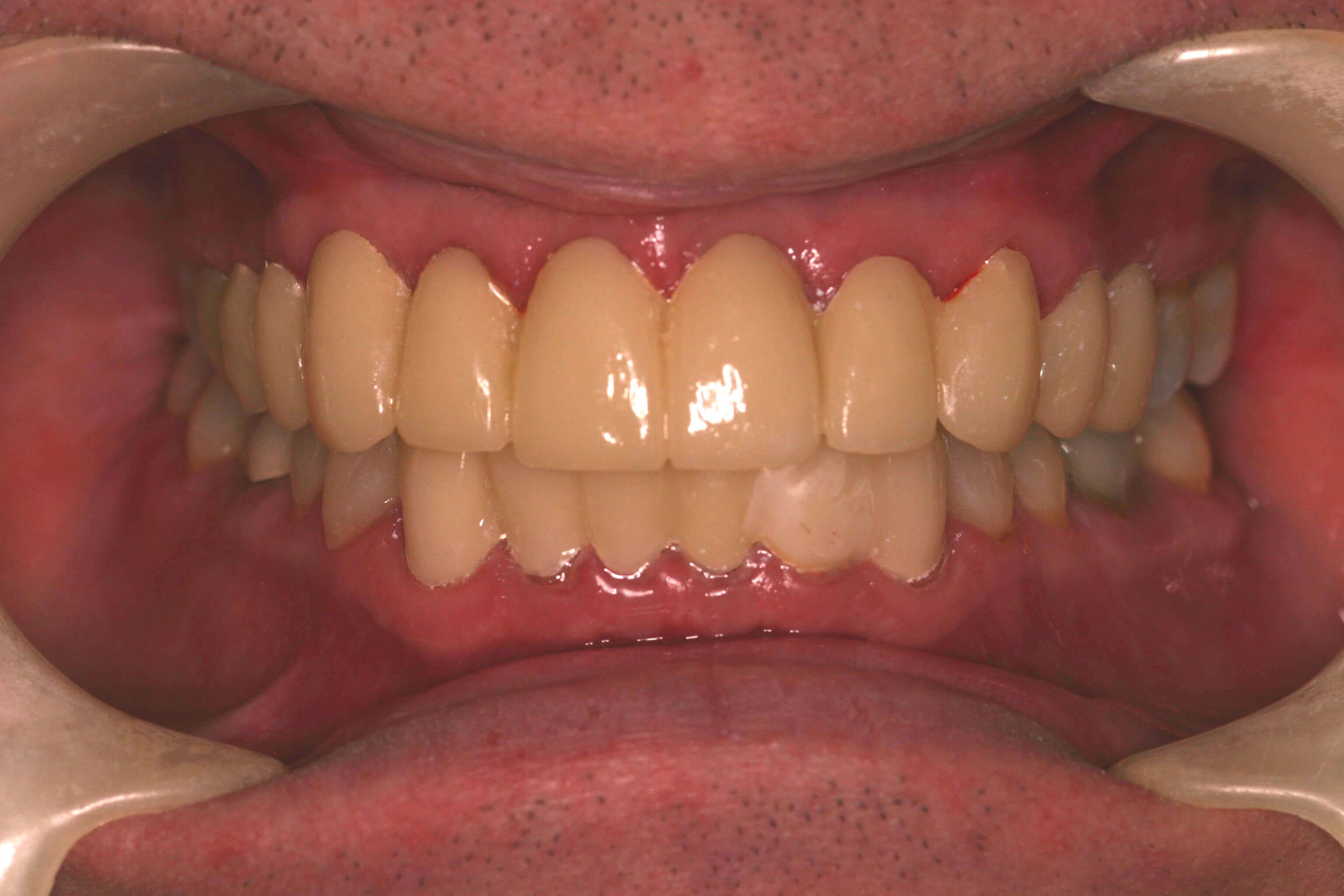 Temporary Provisional Teeth Smile With Temporaries