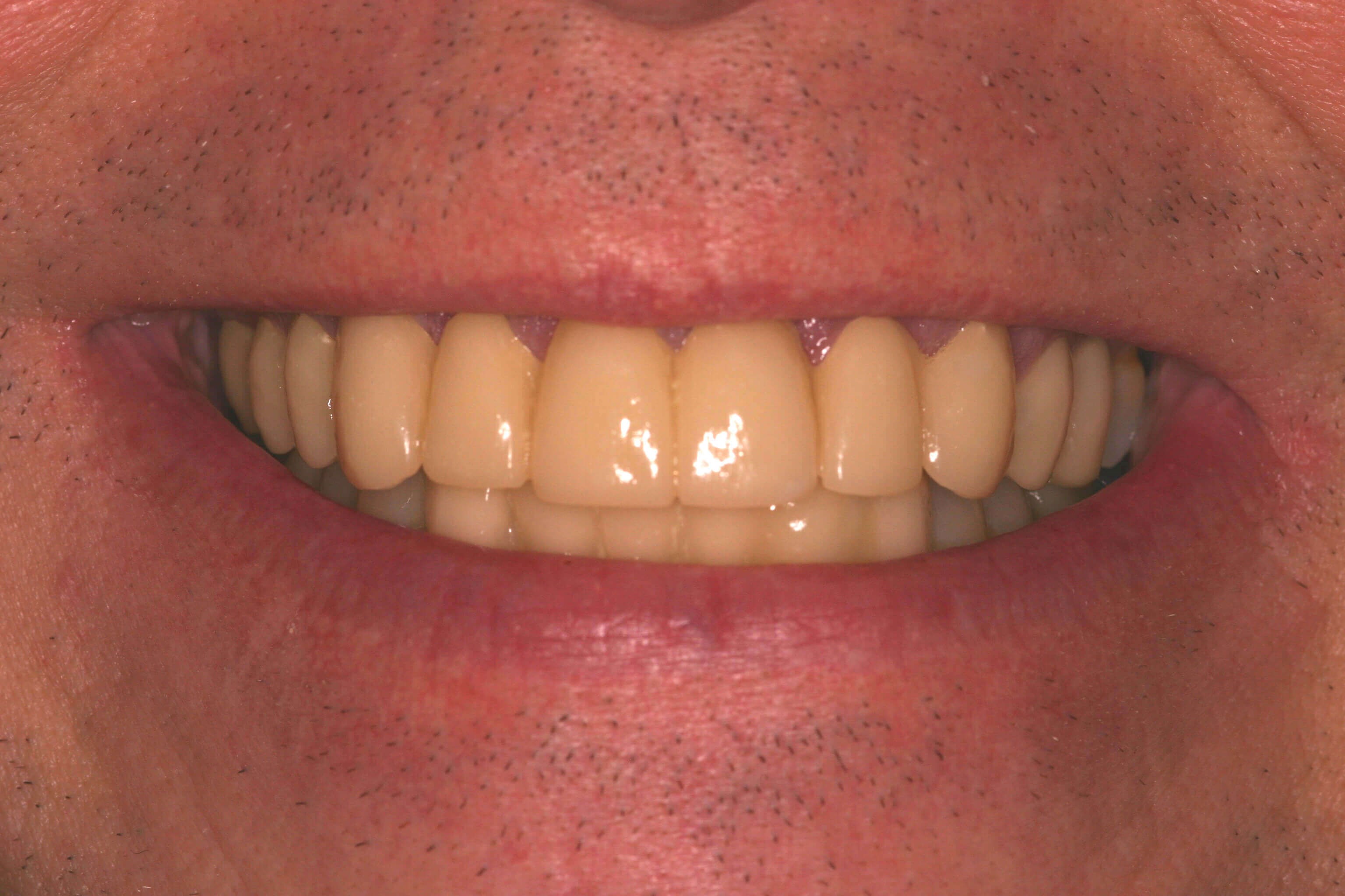 Temporary Provisional Teeth Smile With Temporaries