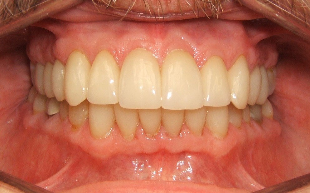 Final Restorations Completed Final Retracted