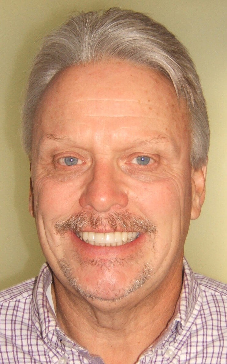 Final Restorations Completed Final Smile