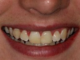 Smile Before Before